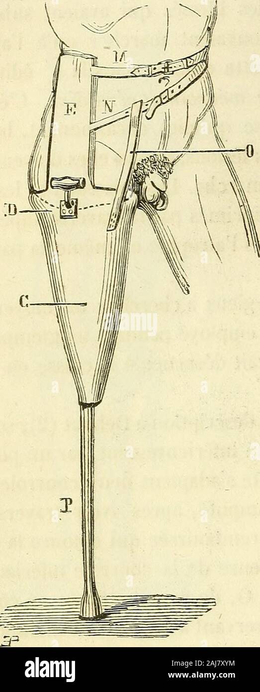 Arsenal de la chirurgie contemporaine : description, mode d'emploi, et appréciation des appareils et instruments internationaux en usage pour le diagnostic et le traitement des maladies chirurgicales, l'orthopédie, la prothése, les opérations simples, générales, spéciales et obstétricales . avec cette différence que le cône creux est remplacé par une légèreexcavation ; les courroies qui lattachent au bassin ne suffisent pas à luiconserver une fixité camping also, les opérés ne peuvent lutilizer quàla l'état d'être doués dune très-grande adresse. Toujours lappareil sedérange position assise la poignée, et Banque D'Images
