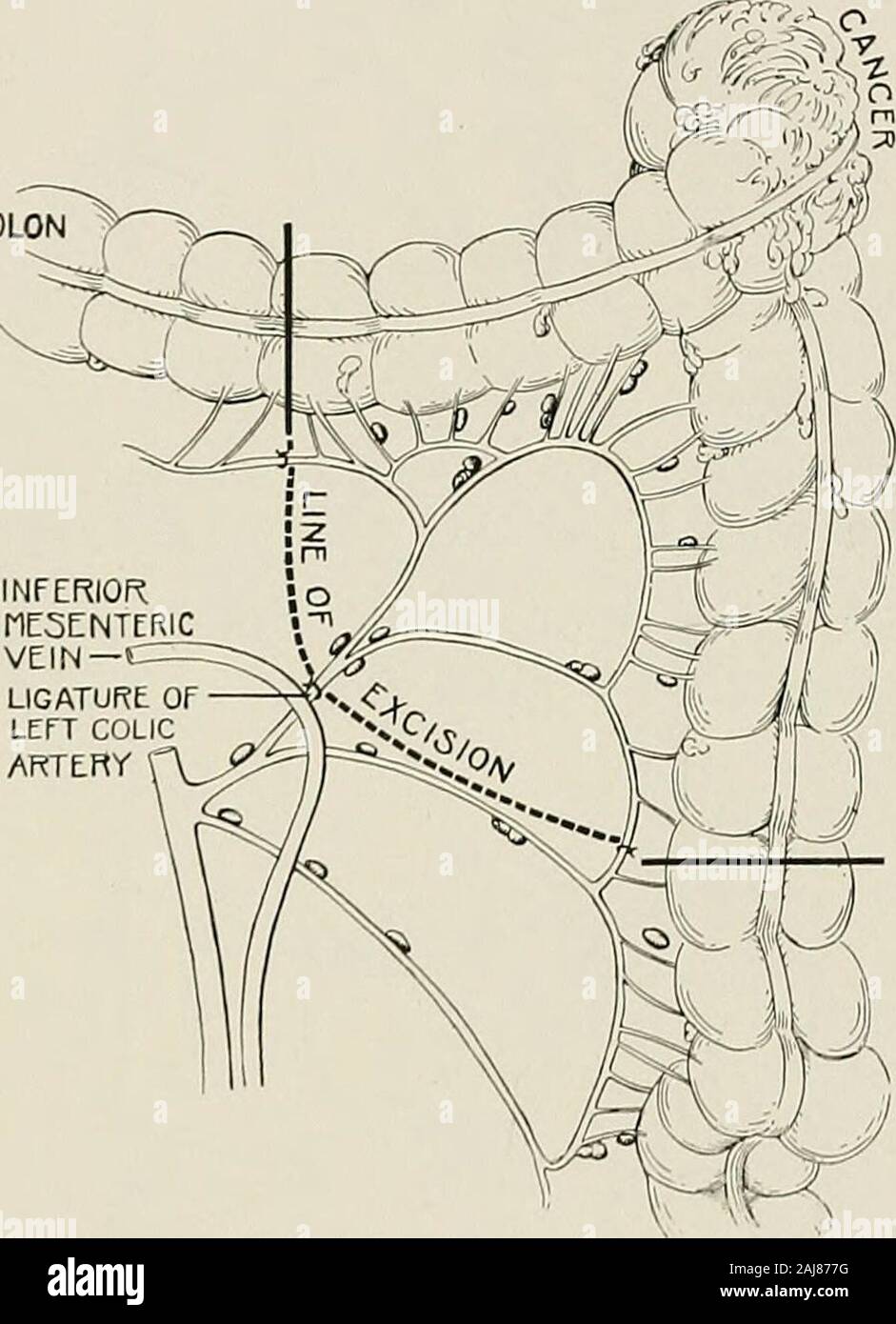 Traitement chirurgical ; un traité sur les pratiques de traitement des maladies chirurgicales pour l'usage des praticiens et des étudiants de chirurgie . olicdownward. L'opération consiste à exposer l'artère mésentérique inférieure 592 TRAITEMENT CHIRURGICAL et la lier et la veine juste en dessous du lieu d'origine de l'artère colique gauche.le mésosigmoïde est ensuite divisé à partir du point de trompes à themiddle le sigmoïde de flexion. Les arches de la secondaire arteryshould sigmoïde pas être endommagé. Le péritoine est ensuite divisé le long de la innerside de l'artère à l'intérieur du mésorectum. L'lymphat Banque D'Images
