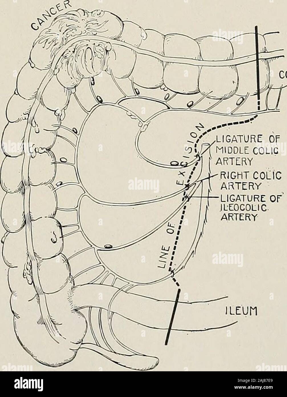 Traitement chirurgical ; un traité sur les pratiques de traitement des maladies chirurgicales pour l'usage des praticiens et des étudiants de chirurgie . la partie inférieure du côlon sigmoïde et partie supérieure du rectum,les glandes qui nécessitent la dépose soient dans l'artère mésentérique inférieure. Deux-points Fig. 1240.-Cancer de l'angle colique droit de Colon.montrant l'étendue de l'intestin grêle et mésentère à déposer. et l'artère hémorroïdale supérieure à partir de l'origine de la gauche. colicdownward L'opération consiste à exposer l'artère mésentérique inférieure 592 TRAITEMENT CHIRURGICAL et la lier et la veine juste en dessous du lieu d'origine de Banque D'Images