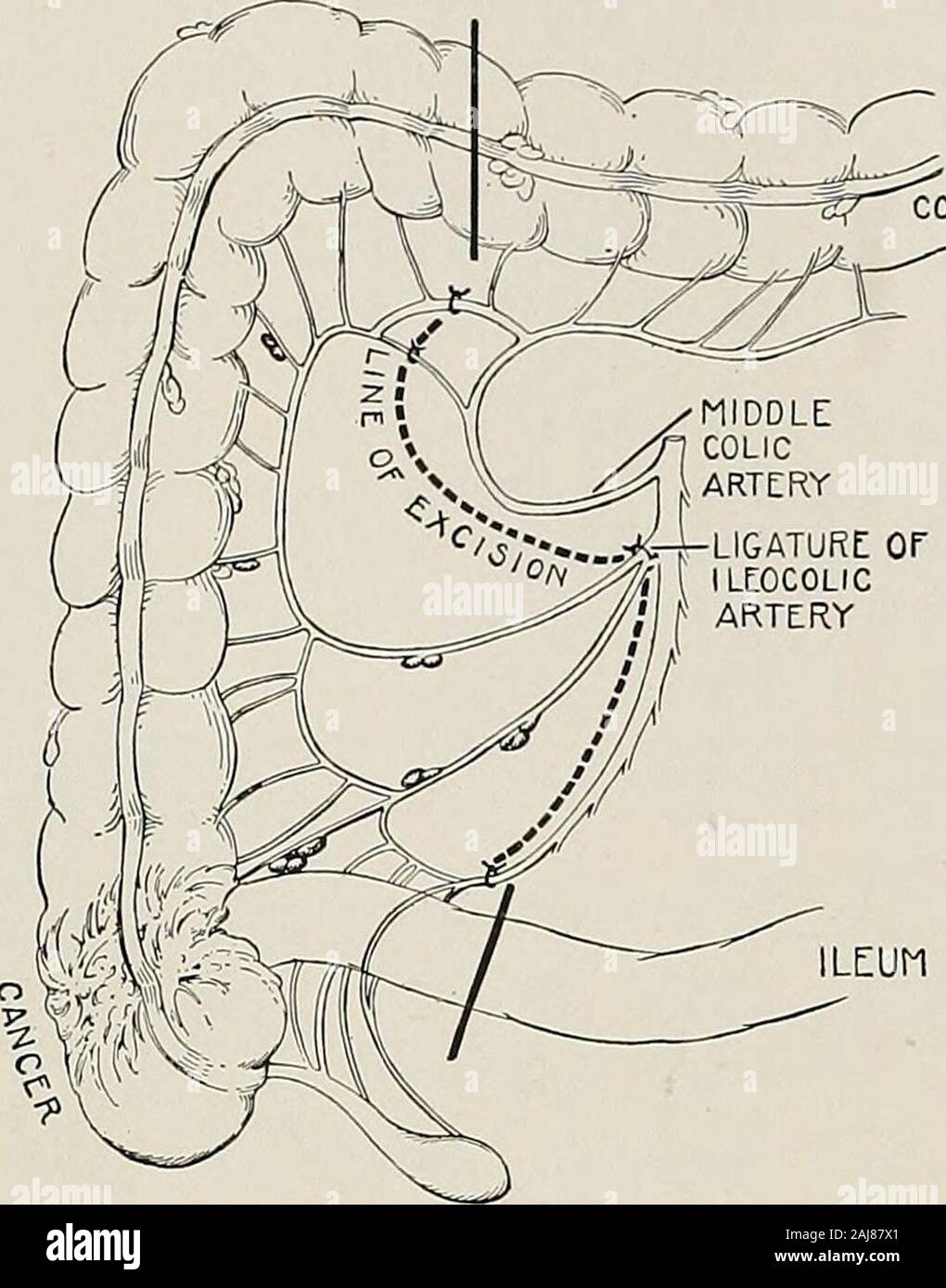 Traitement chirurgical ; un traité sur les pratiques de traitement des maladies chirurgicales pour l'usage des praticiens et des étudiants de chirurgie . grand tube en verre permet le drainage de l'intestin obstrué et permis le maintien de la peau et nettoyer la plaie. Pour la dépose du cancer au milieu du côlon transverse, le lymphaticslie à proximité de l'intestin, et il est uniquement nécessaire de déposer 8 ou 10 cm. (3 ou 4 pouces) de chaque côté de l'intestin de la croissance avec le attachedwedge mésocôlon de. Pour le cancer près de l'angle colique gauche, l'artère colique gauche doivent être exposés asit quitte la veine mésentérique inférieure Banque D'Images