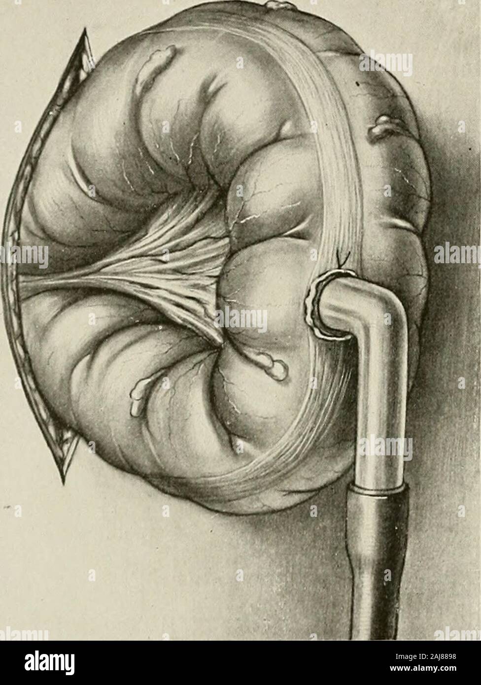 Traitement chirurgical ; un traité sur les pratiques de traitement des maladies chirurgicales pour l'usage des praticiens et des étudiants de chirurgie . une résection radicale exige le retrait de la partie inférieure de 15 cm. (6po) de l'iléon et le côlon au-delà de l'angle colique droit. Le lowerborder de la troisième partie du duodénum doivent être exposés, le péritoine 590 TRAITEMENT CHIRURGICAL divisé et le ileocolic navire surpris. Le tissu gras autour de l'vesselsshould être dépouillé vers le bas avec de la gaze, et l'artère et la veine hupés delloret liée l'artère mésentérique supérieure. Puis le filtre correspondant du méso-colon et de l'intestin Banque D'Images