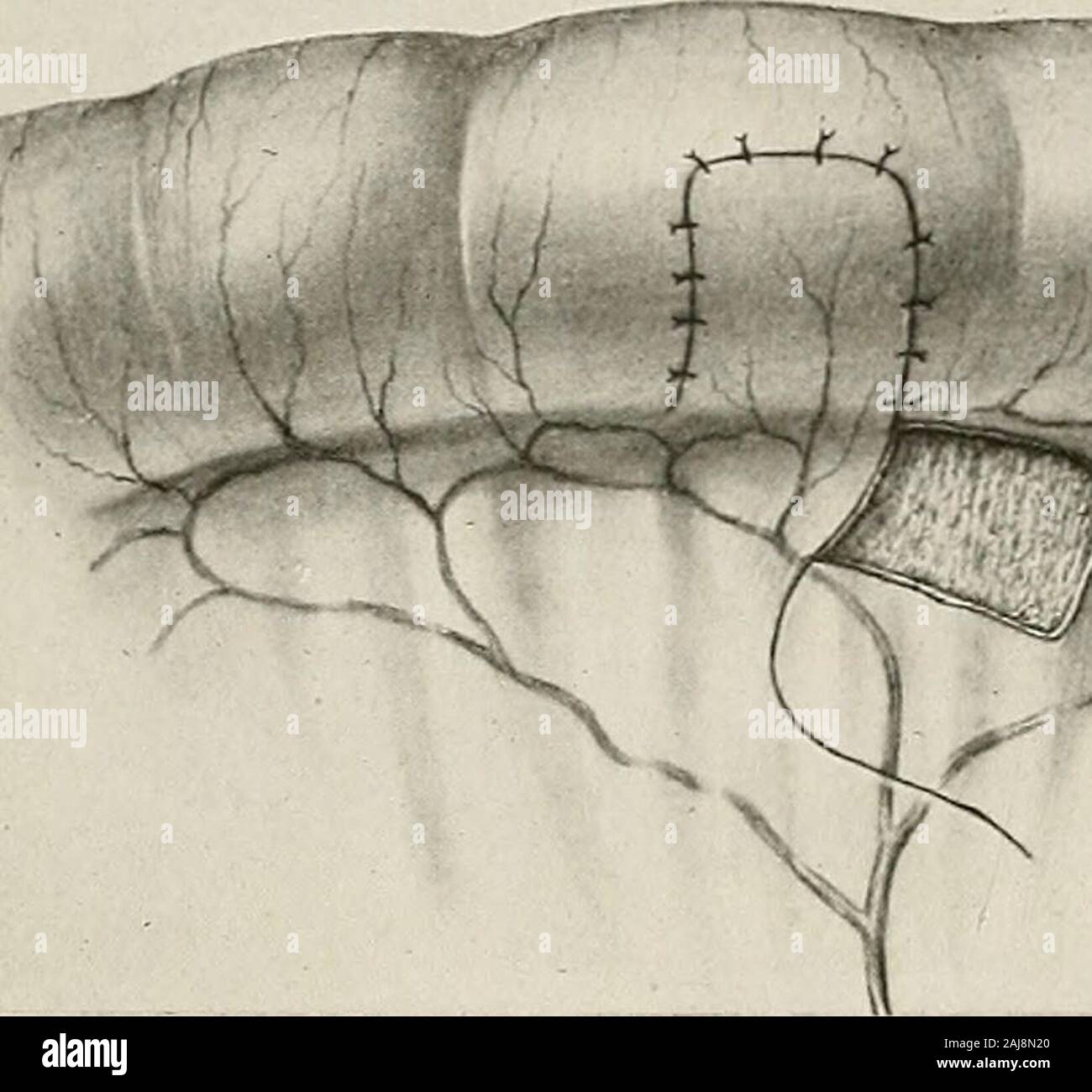 Traitement chirurgical ; un traité sur les pratiques de traitement des maladies chirurgicales pour l'usage des praticiens et des étudiants de chirurgie . il hepaticobstruction autour de la circulation systémique. Toutes les surfaces péritonéales de suture, si important dans l'estomac et intestinaloperations, dépend de l'irritation causée par les incisions par theperitoneum et à l'irritation des sutures, pour couvrir la blessure et la fibrine en plastique avec des sutures en quelques heures, ou minutes, après clôture de l'opération. Corps étrangers aseptique dans le péritoine gauche encapsulé thusbecome (voir les adhérences, pa Banque D'Images