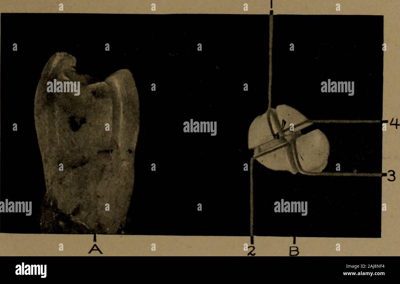 Un texte-livre d'Histologie et Embryologie dentaire, y compris les directions de laboratoire . Email sur la pointe de la cuspide de la dentine dentine : D, point. (80 X) d'samesection comme Fig. 90. Les zones de faiblesse pour les marges de l'ÉMAIL 127 de la garniture. Si début de carie dans la gorge ou hasextended fosse seulement pour le point C, fig. 90, le mur peut être trimmedin le plan axial et un mur idéal produit ; mais s'il hasreached point D, fig. 90, il doit être incliné pour bucally, retirez l'extrémité de l'asto la veille, comme indiqué dans le dottedline, et l'aube restauré par le matériau de remplissage. La surface de Theregion indiqué par Banque D'Images