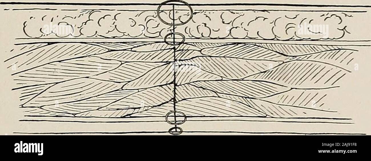 Traitement chirurgical ; un traité sur les pratiques de traitement des maladies chirurgicales pour l'usage des praticiens et des étudiants de la chirurgie . -ThePeritoneum à coudre.Le péritoine isgrasped par deux colliers insuch une manière qui theserous les surfaces sont opposés, c'est levé à l'avant, et le pli shipment outside Canada & USA israpidly l'aiguille passe à travers les deux côtés de la blessure. L'ABDOMEN 517 souhaitable de renforcer la paroi abdominale, cela devrait être un chevauchement-ping suture. Le muscle ne doit pas être adopté dans ce fil.. Fig. i 190.-Diagramme de plaie abdominale suturée complètement en couches.péritoine, fas transversalis Banque D'Images