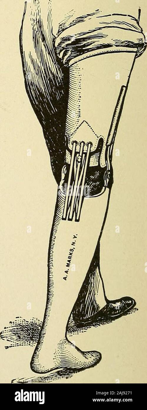 Travaux préparatoires et après le traitement dans le cas du dispositif flexible . On vient de parler. La prise en ishollowed près du fond et anabundance de prix fournis, allowingof la libre circulation de l'air. Le legsocket pied et core sont faits d'un singlepiece de bois. Le pied en caoutchouc est con-structed comme déjà indiqué (Fig. 390et 391). Fig. 404 et 405 sec afficher les vues d'un appareil pour le but. Les souches tibial court qui sont deux ou Fig. 406. - Appareil forShort moignons tibiaux. plus de pouces de longueur avec les kneearticulation capable d'une gamme de mo-tion à 90 degrés ou plus, peut être avantageux Banque D'Images