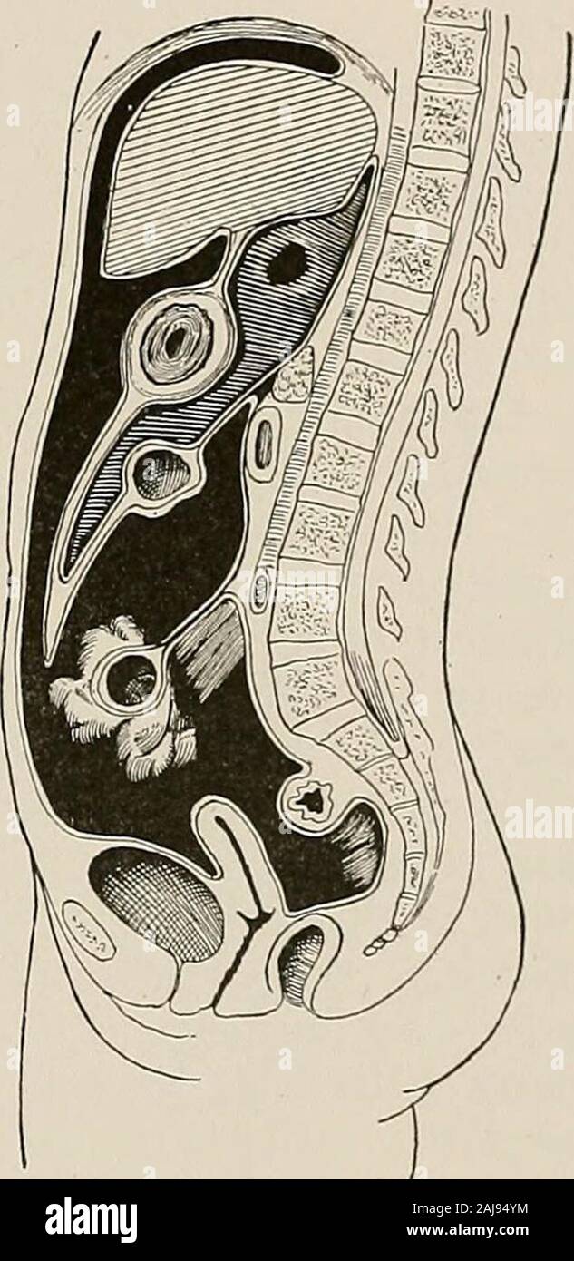 Traitement chirurgical ; un traité sur les pratiques de traitement des maladies chirurgicales pour l'usage des praticiens et des étudiants de chirurgie . er pilier de l'anneau externe est fixéeau il. Ligament Pouparts représente le bord inférieur du muscle oblique externe et y joint fasciae. Les courbes légèrement vers le bas et il se connecte le superiorspine-antérieur de l'ilium et de la colonne vertébrale. L'anneau de l'abdomen interne se situe à 1,3 cm.(^ pouce) au-dessus du centre de Pouparts ligament. L'anneau de l'abdomen externes est situatedabove l'extrême extrémité intérieure du ligament Pouparts. Il est juste au-dessus et à l'externe Banque D'Images