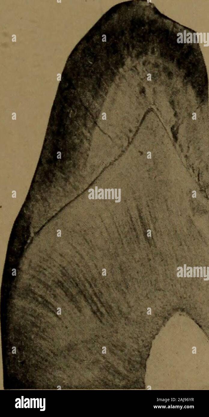 Un texte-livre d'Histologie et Embryologie dentaire, y compris les directions de laboratoire . La préparation de l'émail murs de la cavité de la Fig. 55 l'émail légèrement vers l'orifice buccal, mais theenamel a attaqué sur la surface, s'étendant vers le plus simple de préparation linguale cavités occlusales 97 que l'émail a été sapé à la dento-enameljunction. L'application de la gouge pour la surface, le underminedenamel est divisé, comme l'est indiqué en Fig. 56. Le buccalwall est prévu jusqu'à ce qu'il est dans le plan axial, et la cavo-surface biseautée angle. Il n'est pas nécessaire d'étendre Banque D'Images