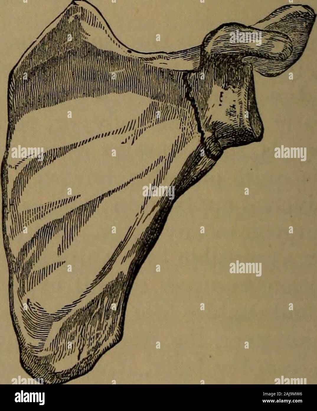 Un traité pratique sur les fractures et luxations . Fracture comminutive du glenoidcavity. Fracture du col de l'omoplate ; selon industrielle Astley Cooper. des qu'il a établie par une dissection. L'Apophyse coracoïde processwas casse en même temps, mais la fracture par l'surgicalneck wTas distincte de ce ; et Sir Astley a enregistré trois ex-samples dans lequel le diagnostic a été très clairement établie, mais pas actu-ally prouvé par une autopsie. Les FRACTURES DE L'acromion. 215 en chirurgie Holmess il est précisé qu'il existe un seul spécimen dans themuseum de gars à l'hôpital ; un autre, en Banque D'Images