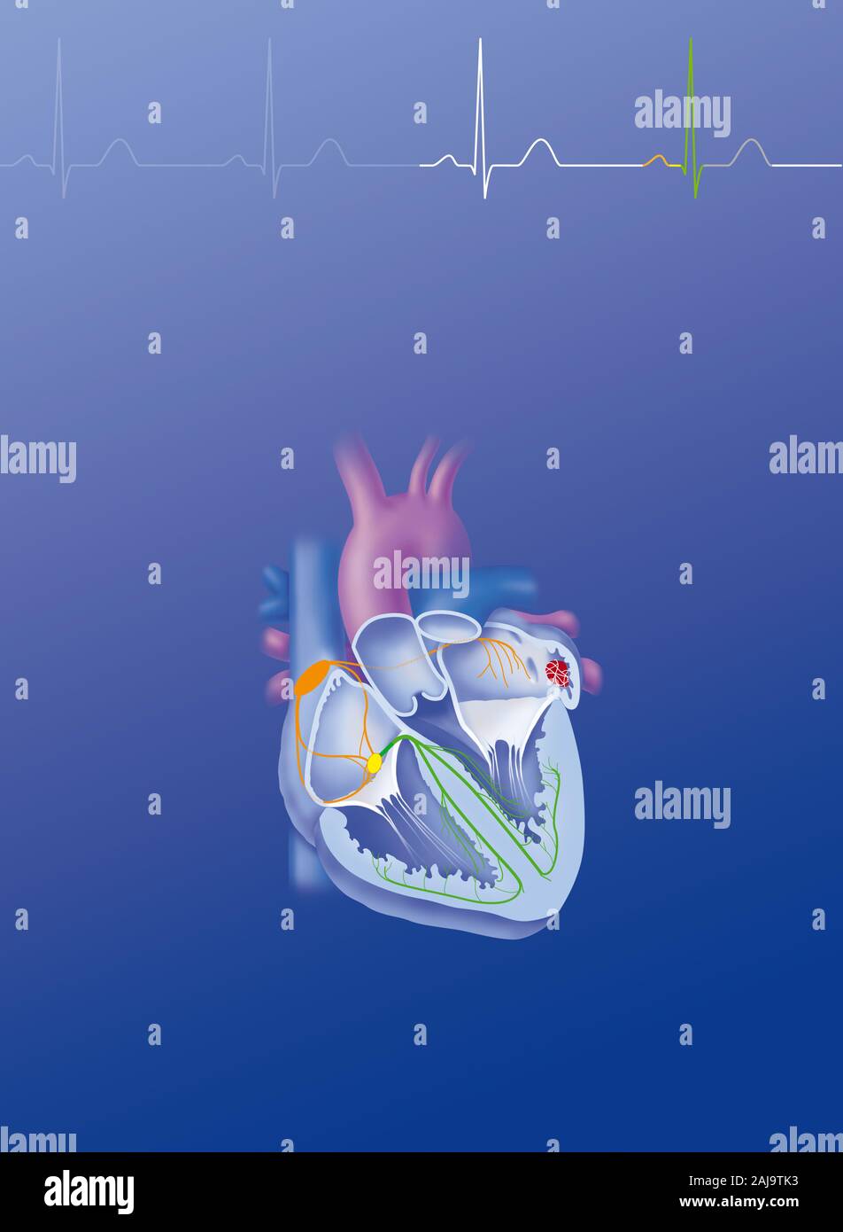 La fibrillation atriale Banque D'Images