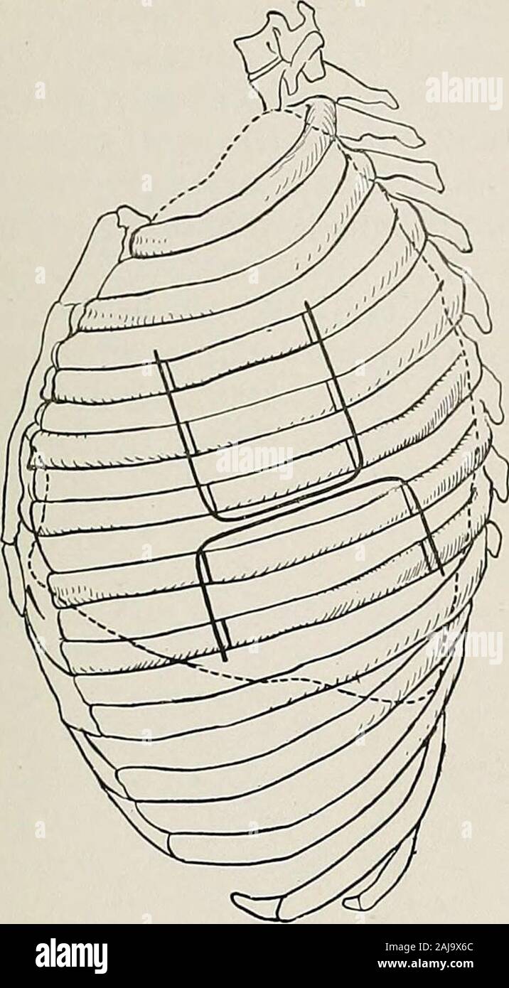 Traitement chirurgical ; un traité sur les pratiques de traitement des maladies chirurgicales pour l'usage des praticiens et des étudiants de chirurgie . n incision peut être présentée par l'intermédiaire de la plèvre dans anydirection. Si vous le souhaitez, l'espace intercostal structures peuvent être enlevées à l'theribs, laissant la plèvre seul ou avec l'épanchement de l'periosteumattached rib. Lorsque la plèvre a été épaissi par l'empyème ancienne, il iseasy pour séparer les côtes avec leur périoste. S'il est nécessaire de fermer le reste de la cavité pleurale sur ofinfection compte qui est d'être exposés dans les poumons, la plèvre pariétale m Banque D'Images