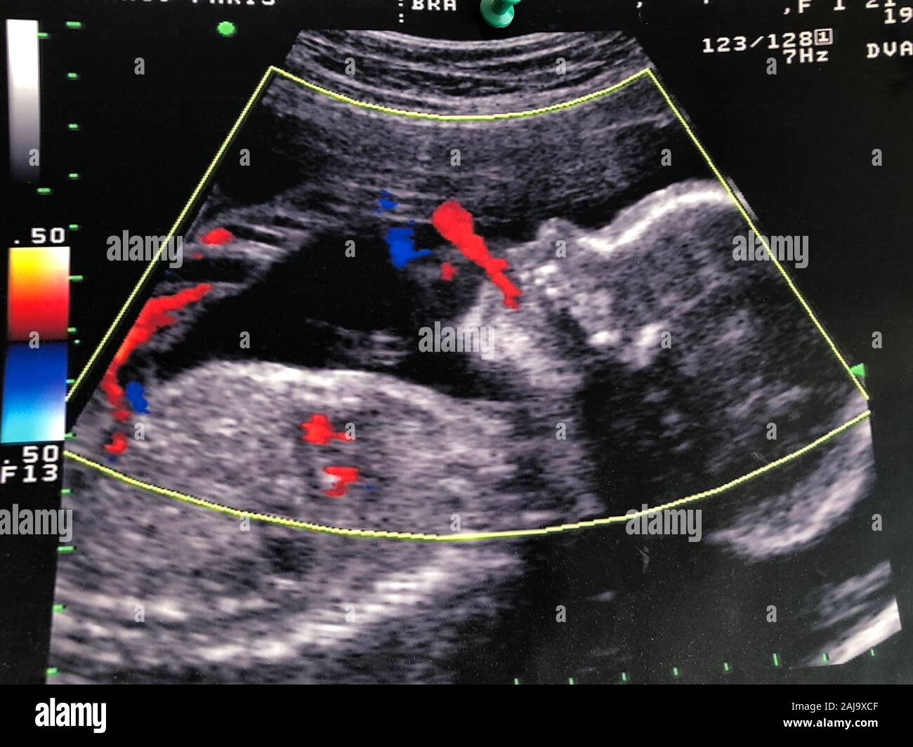 L Echographie Fœtale D Un Fœtus Sa Tete Est De Profil Et Il Expulse Le Liquide Amniotique De Sa Bouche Le Cœur Est Visible Au Centre Comme Deux Petites S Rouge Photo Stock