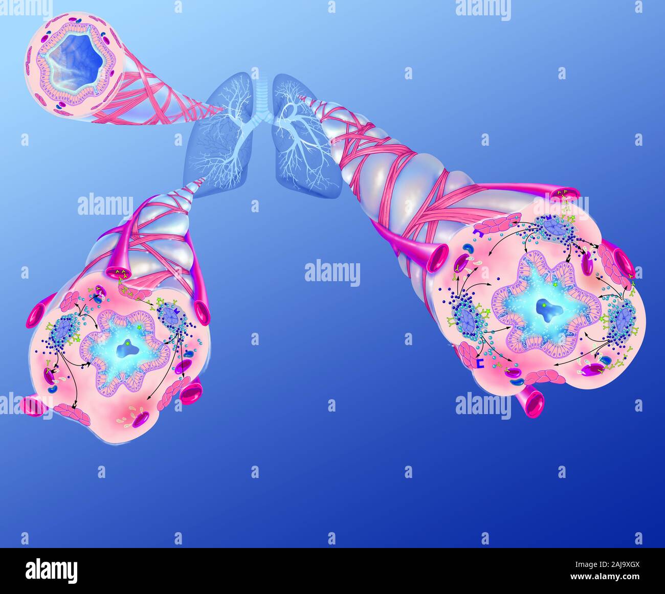 L'asthme et de ses traitements pour prévenir l'obstruction des voies aériennes. Représentation des poumons avec l'arbre bronchique à partir de laquelle 3 zooms. Dans le coin supérieur gauche, un sain, ci-dessous, deux bronchioles bronchioles asthmatiques. Un allergène (étoile verte) déclenche l'asthme par l'activation de lymphocytes produisant des IgE (Y) verte menant à de la dégranulation des mastocytes (mauve) qui libèrent les leucotriènes (perles) et des cytokines (perles bleues) médiateurs de l'inflammation de la muqueuse, ce qui entraîne une bronchoconstriction de fibres musculaires lisses, l'hypersécrétion de mucus et l'obstruction des voies respiratoires. Banque D'Images