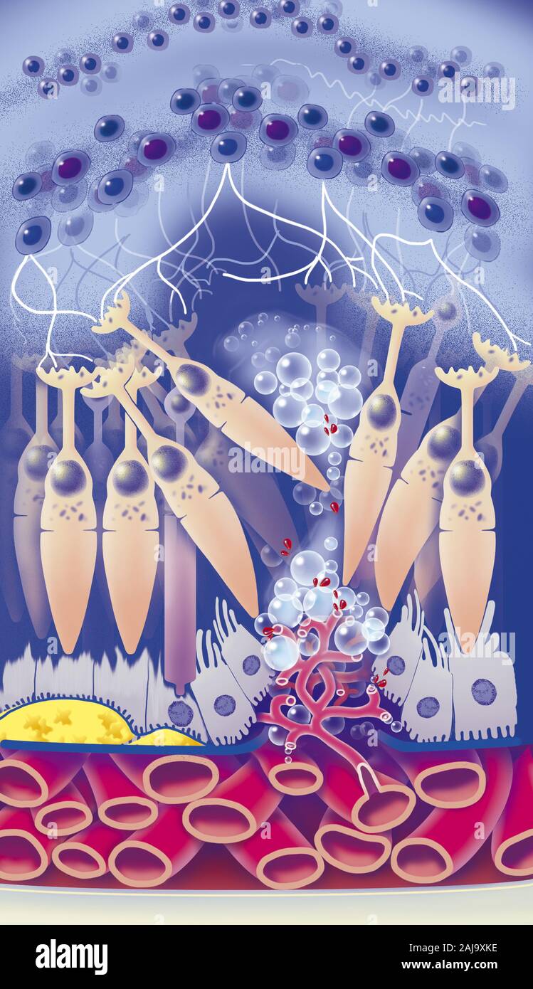 Zoom sur la rétine au niveau de la macula atteinte de dégénérescence maculaire (DMLA). Une néovascularisation se développe au niveau de la choroïde , traverse la membrane de Bruch et provoquer oedème et le décollement de l'épithélium pigmentaire (mauve) entrainant la destructuration des cônes et des batonnets (orange) qui sont progressivement détruits. Des déchets lipidiques ou Drüsen (jaune) s'accumulent sous la rétine suite à l'altération de l'épithélium pigmentaire. Banque D'Images