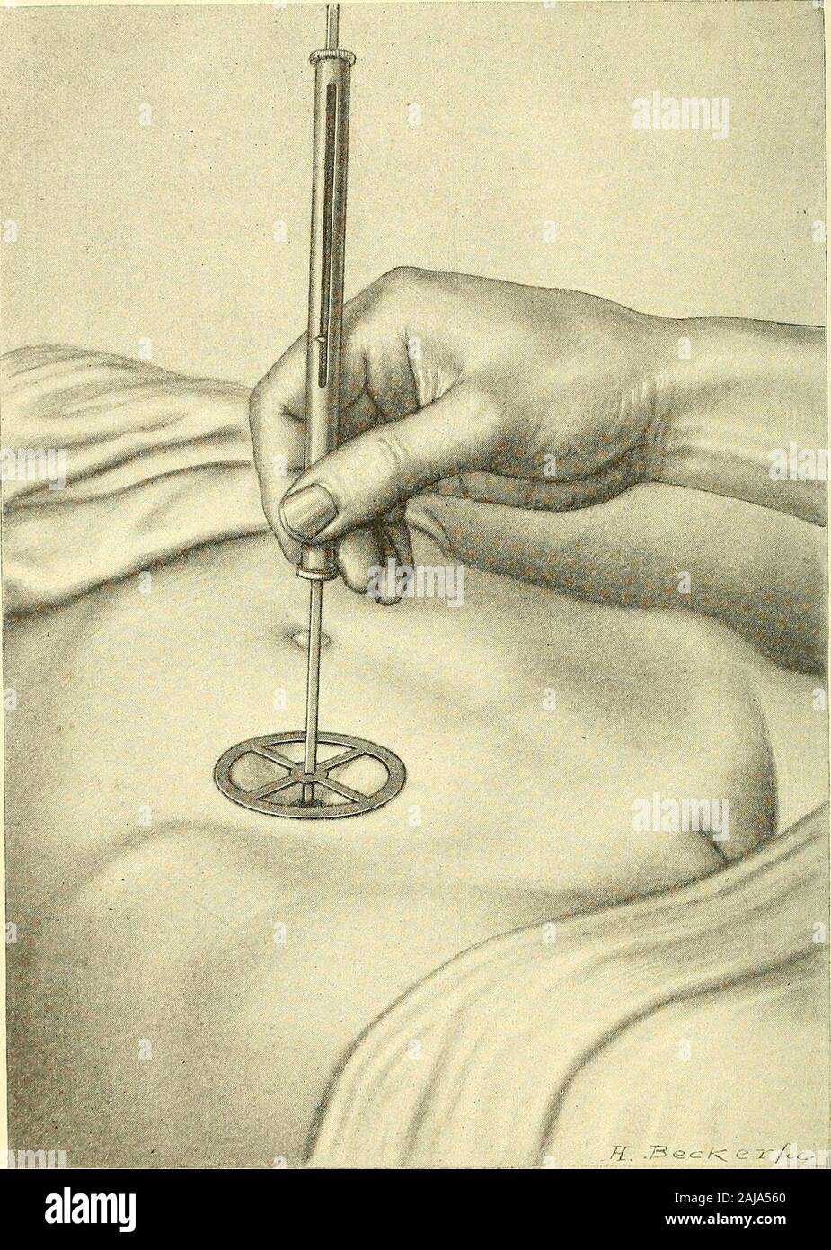 Le gynécologie : . Fig. 63. - Pression sur mesure piézométriques. La ...