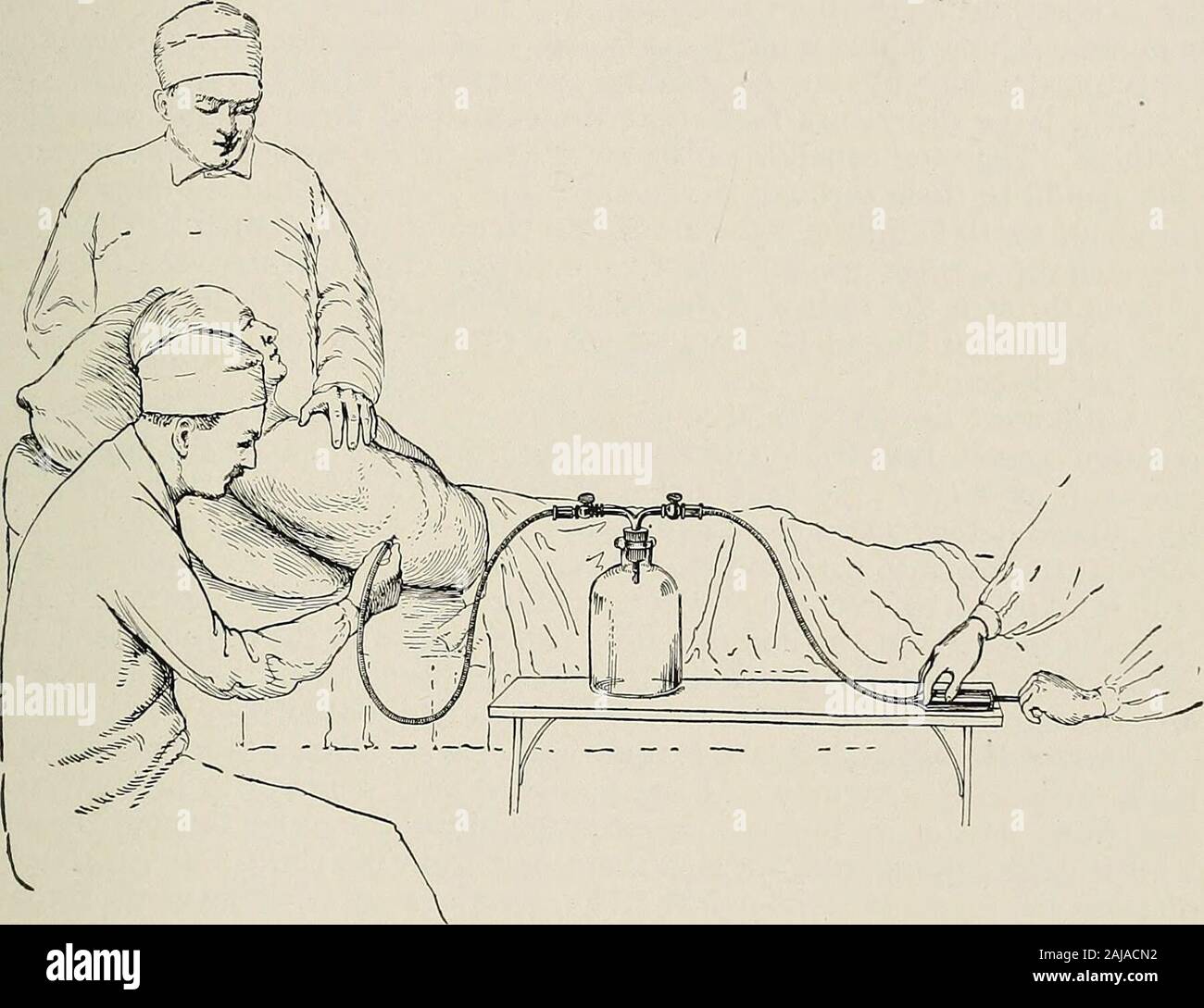 Traitement chirurgical ; un traité sur les pratiques de traitement des maladies chirurgicales pour l'usage des praticiens et des étudiants de chirurgie . mont d'infection peut être surmonter le bv LE THORAX 401 plèvre, et que la présence d'un tube dans un threatensit avec toujours la plèvre non infectée l'infection. Collections non infectés de sang sont capables d'absorption.Si l'infection survient plus tard, l'État peut alors être traité comme de l'empyème. Un hydrothorax, ou non dans le sérum purulent sac pleural, becomesabsorbed habituellement spontanément. Lorsque la quantité de liquide est si grand qu'à em-barrass la respiration ou le cœur, ou Banque D'Images