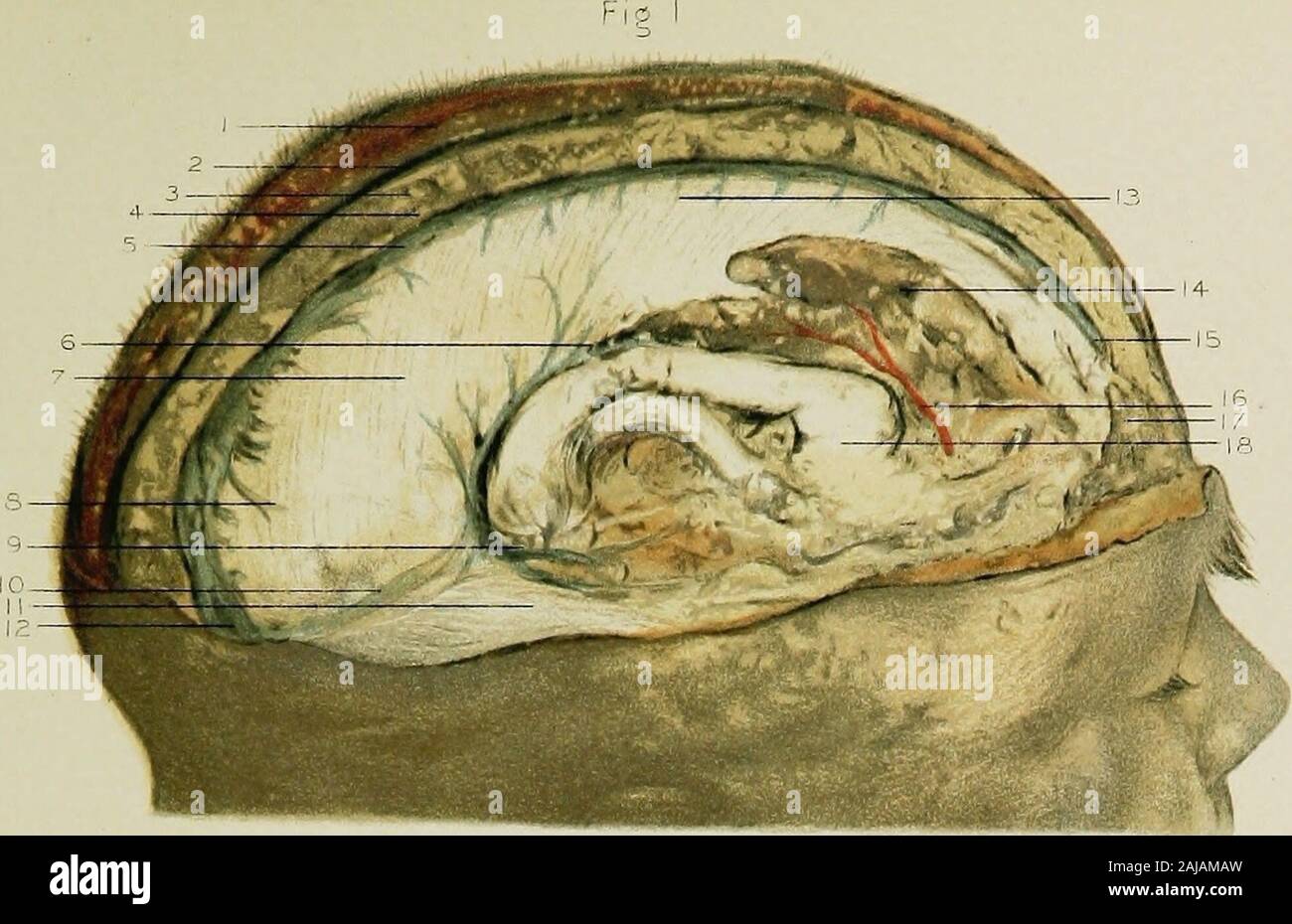 Anatomie régionale dans son rapport à la médecine et chirurgie . n sur la partie postérieure de la racine quatrième cervicalnerve. 17. La gauche sterno-cleido muscle mastoïdien. 18. Le ganglion de la racine postérieure du cinquième nerf cervical. 19. La gauche des nerfs du plexus brachial. 20. Les branches postérieures de l'artère méningée moyenne droite. 21. Les sinus latéraux droit. 22. Le droit sinus occipital. 23. L'artère méningée postérieure droite. 24. Éruptions exanthémateuses transitoires, le droit (ou la première) nerf cervical. 25. Le droit de l'artère vertébrale à sa courbure. 26. L'occipital nerf majeur (ou direction générale interne de l'posterio Banque D'Images