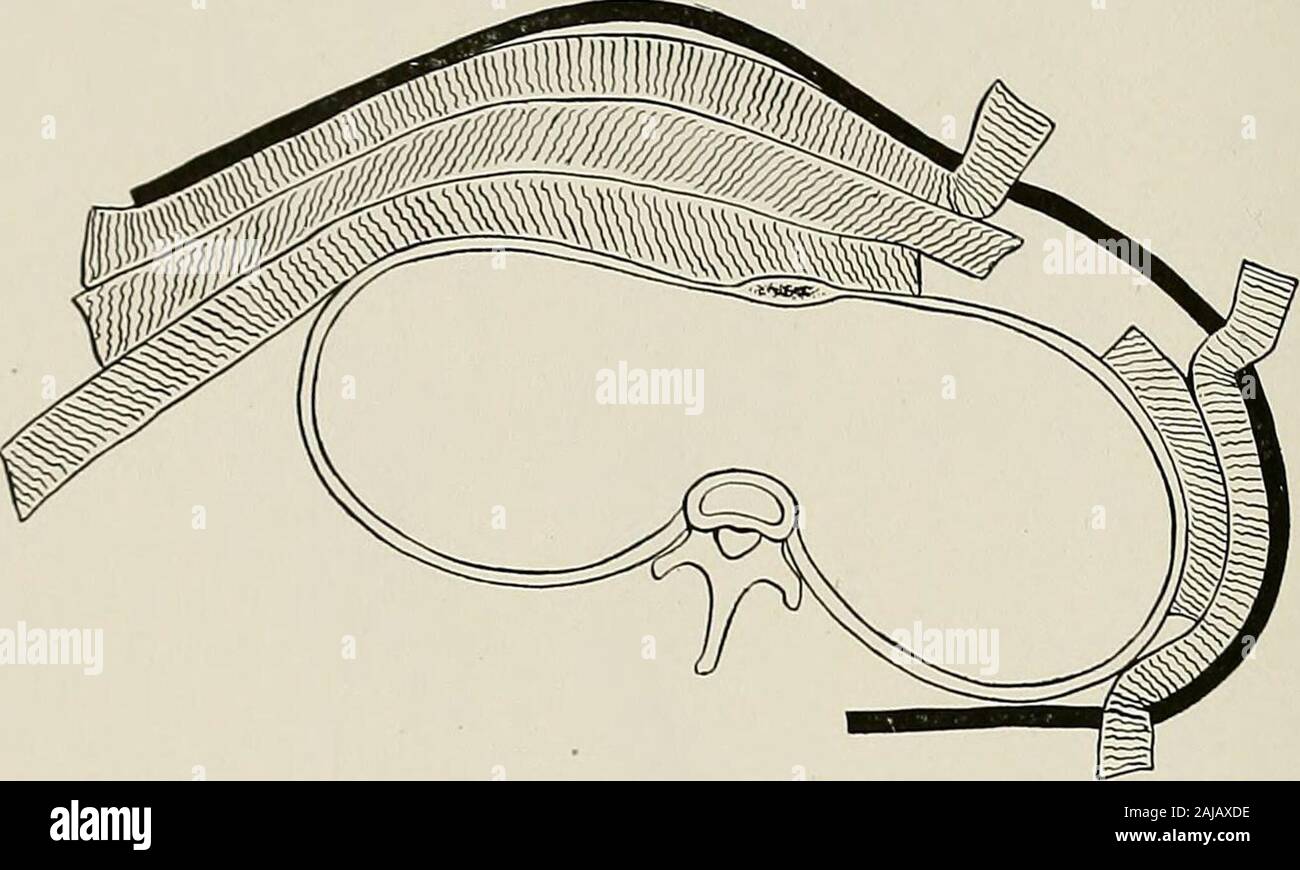 Traitement chirurgical ; un traité sur les pratiques de traitement des maladies chirurgicales pour l'usage des praticiens et des étudiants de la chirurgie . Fig. 1055.--Section montrant les ouvertures du corset de décompression. Coccygodynia (névralgie).-coccygien dans quelques cas une constitutionalor cause locale peut être découvert et retiré. Tumeur, constipation,sacrococcygeal maladies articulaires, ou maladies nerveuses peut être atteint. Il y a souvent un déplacement de l'coccyx et contrainte de mobilité. Peut souvent être 358 secours chirurgicaux 5Trea tment sécurisé par massage vibratoire. Le traitement le plus efficace est de l'indice moyen massageby-doigt dans th Banque D'Images