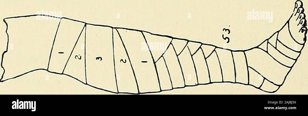 Les principes et la pratique du bandage : par Gwilym G Davis . 52.-Deuxième tour de le bandage du mollet de la jambe.. 53.-bandage terminé du mollet de la jambe, parfois calledthe spica du veau. XI de la plaque, des bandages. 23 monter jusqu'à l'articulation du genou par deux ou trois spirale tourne lentement. Ifdesired, le genou peut être couvert par la même figure 8 tours comme wereapplied à la jambe, et le bandage a continué dans la même mannerup la cuisse. Ce bandage est très admiré et employés par certains. Son chef d'âge advant est sa sécurité du déplacement, et lorsque les patients sont contraints d'utiliser une grande partie du membre, il ne peut Banque D'Images