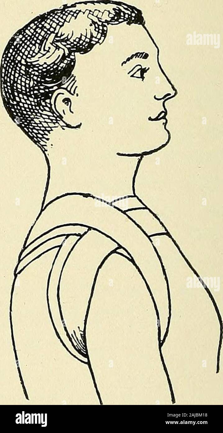 Les principes et la pratique du bandage : par Gwilym G Davis . 39.-bandage Spica de l'épaule.. 40.-Fig. 8 de la bandage shoulderand aisselle. PLATE VIII. Le bandage. Ce faisant 19 le bandage est tiglitened à la flexion du coude et de l'interferencewith la diffusion des résultats. Spica de l'épaule. Ordre Croissant (fig. 39). Bandage, 8m x 2 pouces. L'extrémité initiale est fixé autour de l'humérus à l'inser-tion du muscle deltoïde. Un ou deux reversedturns ou spirale spirale sont effectués jusqu'à ce que le bandage atteint le plis axillaires. Il isthen menées autour de la poitrine, à travers l'autre ax Banque D'Images