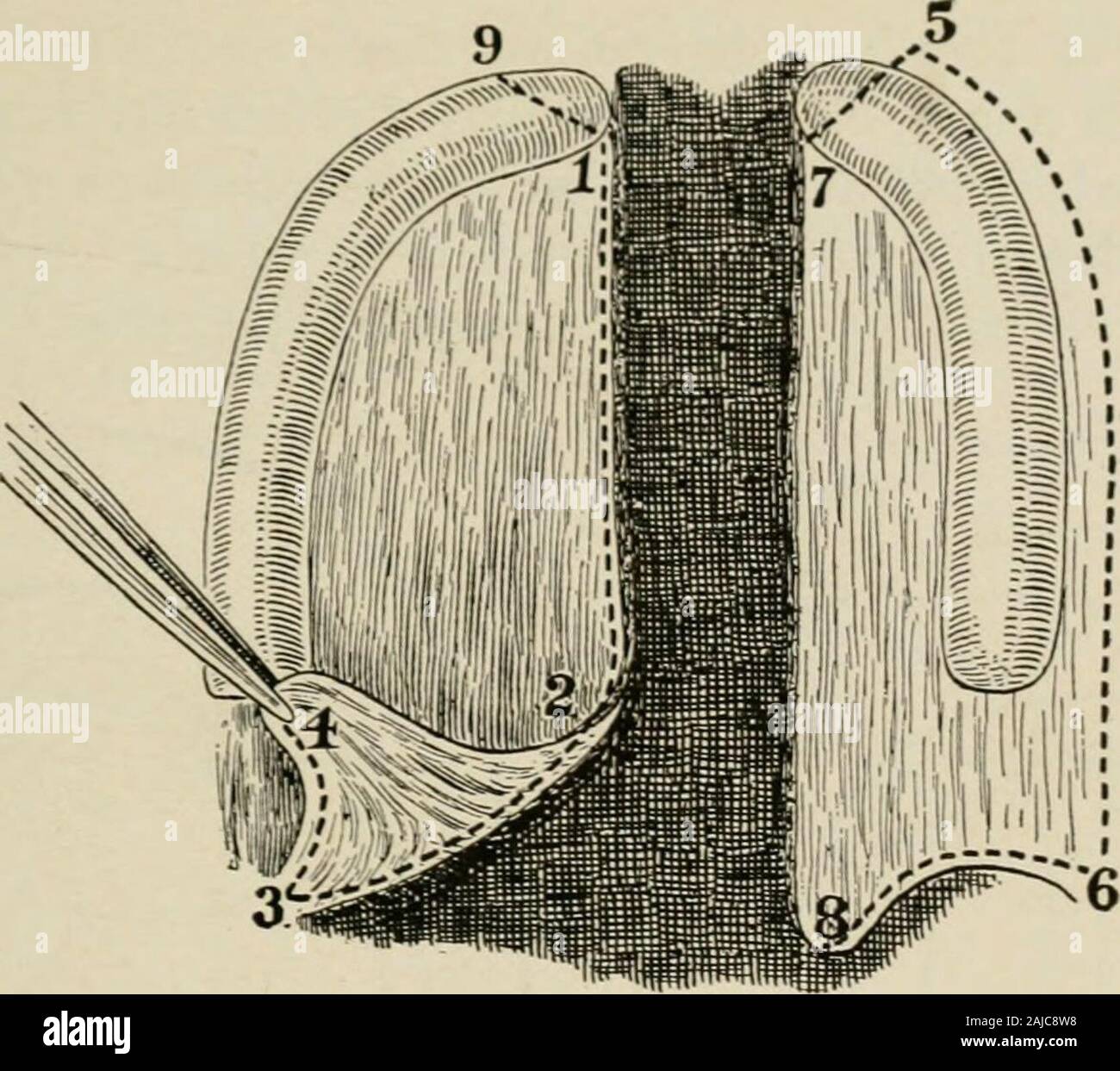 La chirurgie plastique ; ses principes et pratiques . e palais mou towhich la profondeur des tissus sont divisés. Le tissu interne à la ligne FG doit être desserré andturned vers l'intérieur. L'insert représente une section verticale le long de la ligne XY.2. Les marges des volets M et N, et le plan supérieur du palais mou sont suturedtogether. L'insert indique la méthode de tournage et la suture. 3. Le mucoperi-osteal O volet est ensuite attribuée au cours de la ligne suturée et fixé, et le plan inférieur de l'softpalate est suturé. défaut était trop large pour le bord-à-bord de la clôture. Les diagrammes volontaire Banque D'Images