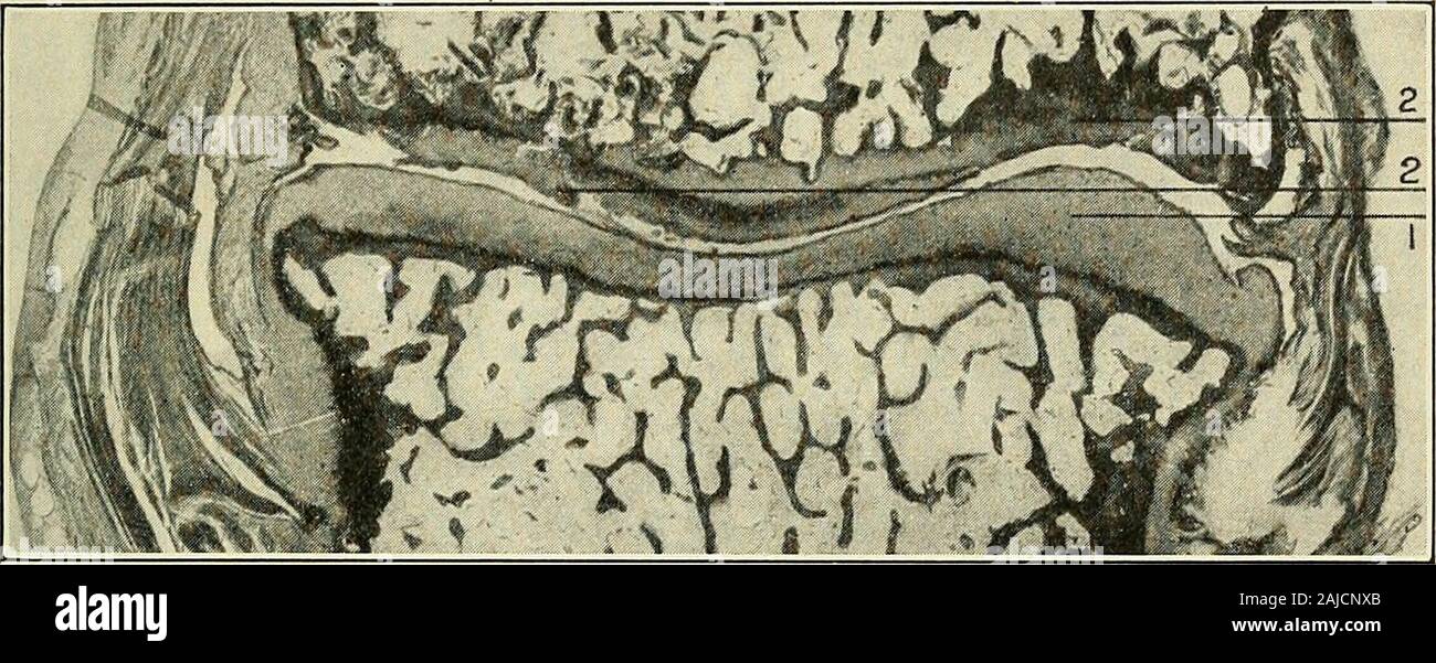 Un traité sur la chirurgie orthopédique . e ou proliférative fonn atrophique qui tend à destroythe le cartilage et mène à anchylosis (Figs. 201-202). La Goutte-goutte. est relativement de faible importance d'theorthoiDedic point de vue. Elle touche plus particulièrement les ofmiddle la vie et elle est caractérisée par inflammation aiguë à punaises suivi par des dépôts d'urate de sodium sur ou sur les surfaces d'thearticular les articulations touchées. Après plusieurs attacksthe le cartilage et l'os peut être en partie détruit, et thejoint peut être élargi par des dépôts dans les tissus périarticulaires et lorsque l'inflammator Banque D'Images