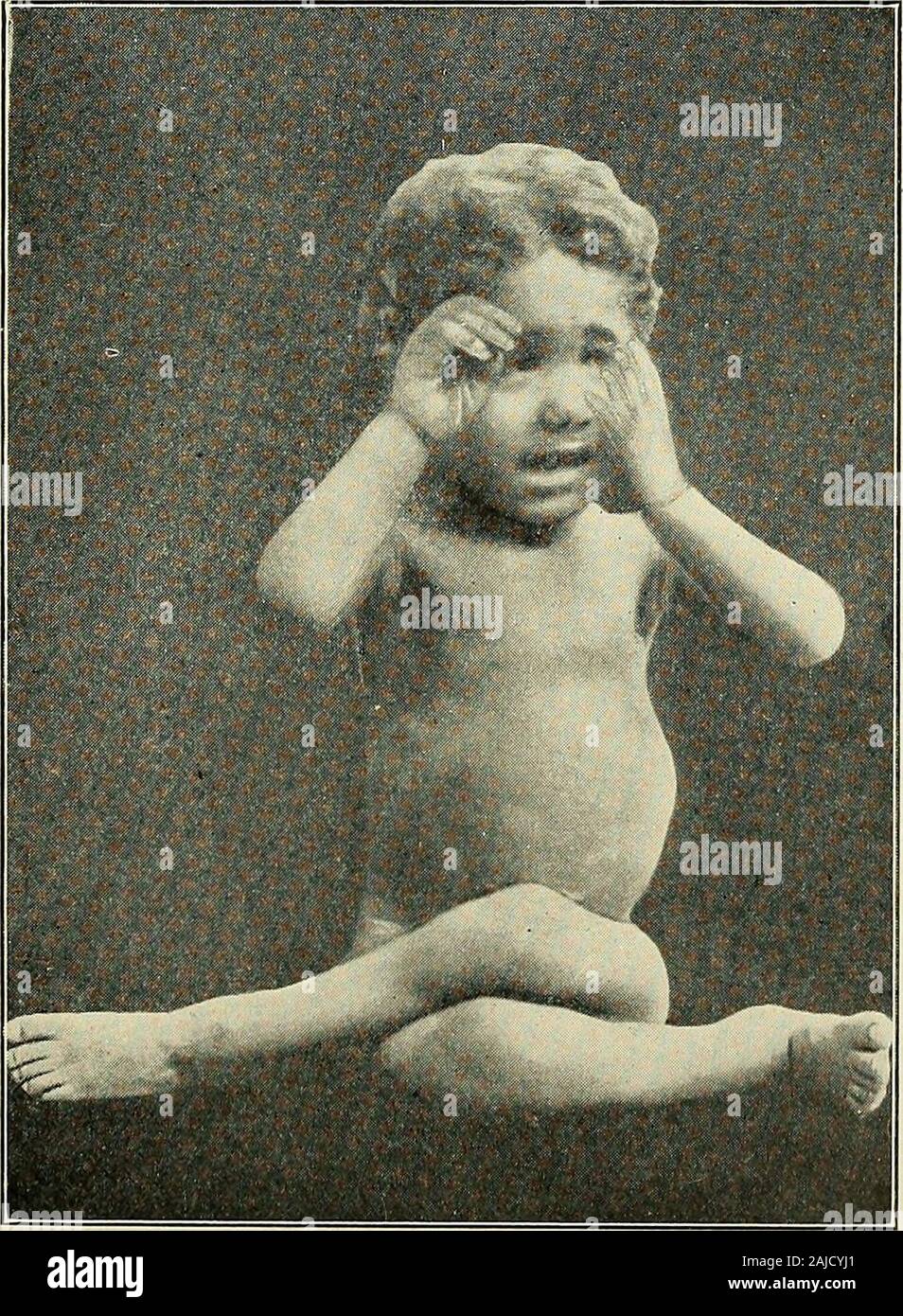 Un traité sur la chirurgie orthopédique . ^ Eoberts au diamètre, Journal American Medical Association, le 3 octobre 1908.^clOrthopeclie Kevue Martirene, Mai, 1903.^Klar, Zeits. f. Orth. Chir., Bd.. xv. Heft 2, 1906.*Zeits. f. Orth. CMr., xxi. Bande. Heft 4, 1908. ^Journal American Medical Association, le 11 septembre 1897, et mai2, 1903. Difformités DE LA COLONNE VERTÉBRALE. 235 le même niveau ; d'où l'indicateur inférieur, le plus long et plus plat,soufflets plus-comme la poitrine. 105-115 L'embryon à la naissance de moins de 2 ans 101 94 ? 3-7 ans 14-18 ans 80 85 72 Adultes Traitement.-Le traitement de la dite poitrine plate est simi-lar à Banque D'Images