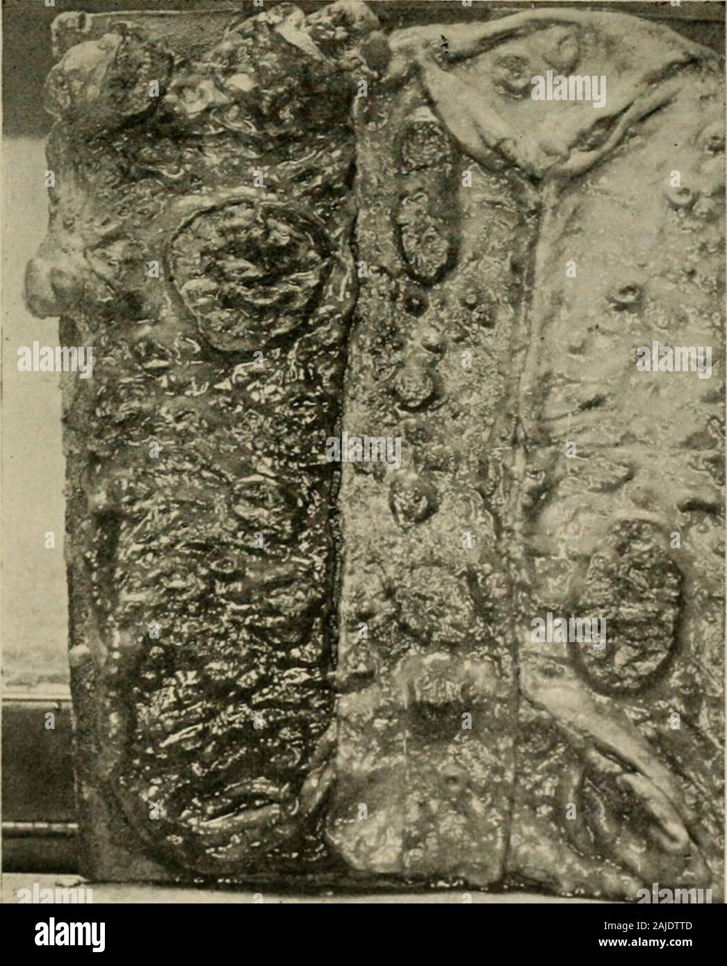 Les maladies des nourrissons et des enfants . ^ l'ulcération superficielle peut être présent, et dans certains cas, il n'y a pas de participation de l'intestin. Theswelling des ganglions mésentériques est habituellement très prononcée et thespleen est toujours très grande et douce ; et ces deux conditions d'aresuggestive ; mais il n'y a rien dans l'autopsie dans infancywhich est positivement le diagnostic de fièvre typhoïde. Dans earlj^ l'enfance, entre les âges de 2 et 6 ans, les lésions arevery similaire à ceux décrits ci-dessus, sauf que le ulcerationis un peu plus marquée. Il est encore, toutefois, ge Banque D'Images