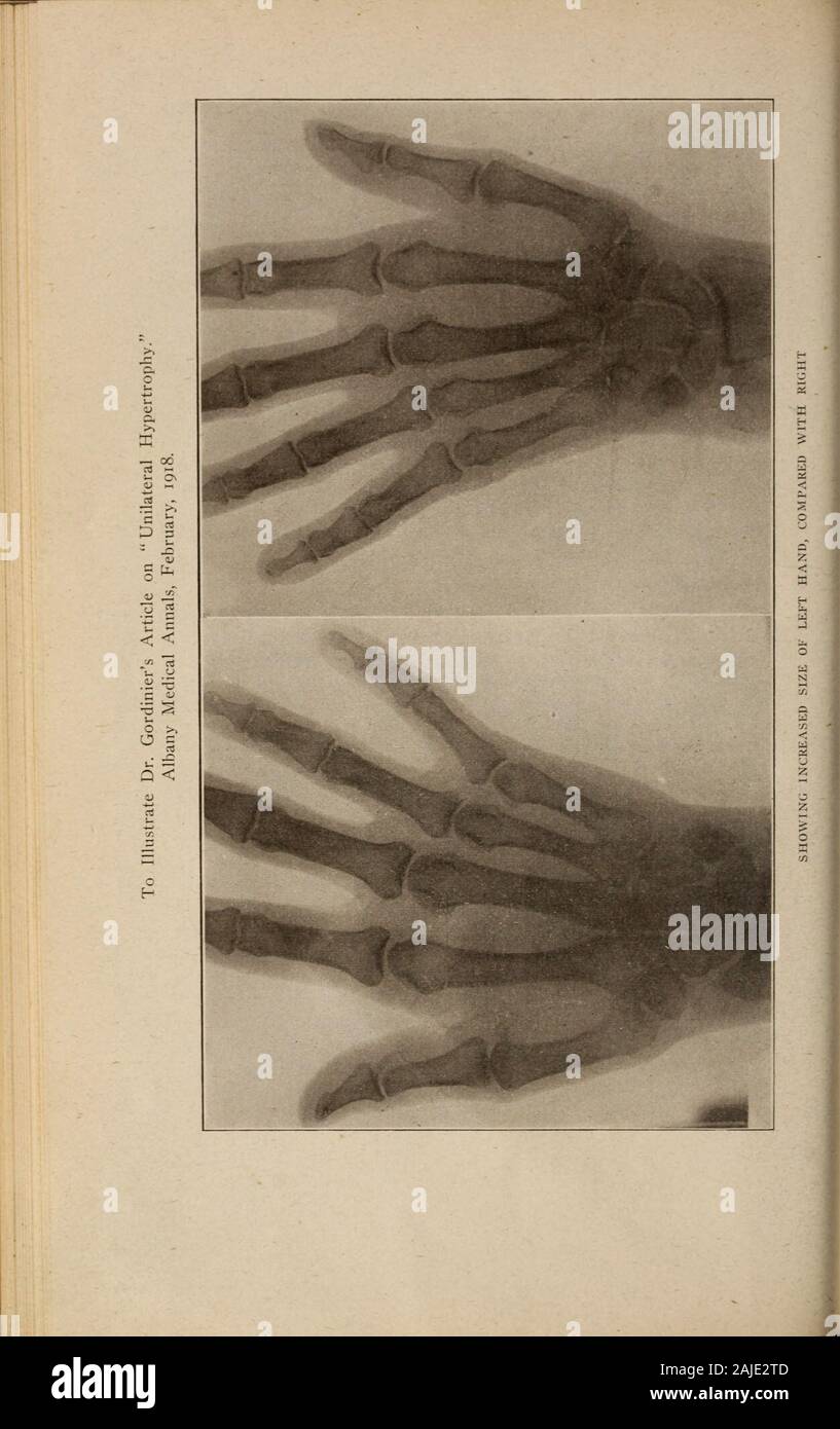 Albany Medical annals . ird plus grande que celle de l'autre côté. Le côté gauche du visage est plus importante que celle de lavis mais l'écart n'est pas aussi marquée que celle de la langue maternelle ;,alors que le côté gauche du thorax est beaucoup plus grand que celui de l'autre côté.Toutefois, la plus grande disparité existe dans la taille de l'extrémité supérieure gauche andlower par rapport à ceux de la droite. C'est particulièrement sensible sur des parti-comparaison de la taille de la main gauche et withthose pied de la droite. Cette différence de taille dans l'ensemble de l'leftside implique non seulement la structure osseuse mais le soft Banque D'Images