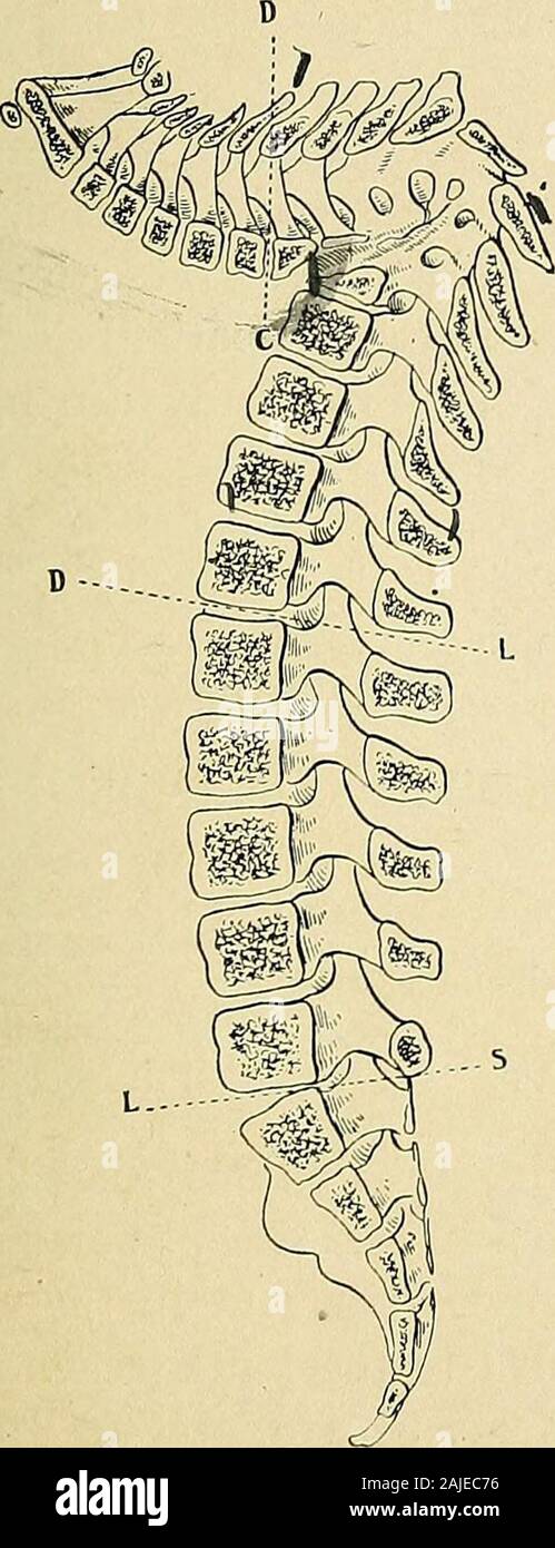 Un traité sur la chirurgie orthopédique . ly limitée à deux oneor les organes adjacents. Erom ce point central il extendindefinitely peut, dans les deux sens, mais dans les cas ordinaires le finalarea de difformité et de rigidité montre que de trois à sixbodies sont plus ou moins impliqués avant traitement est établi. Si la maladie est limitée à l'étendue, l'effet de l'érosion, les surfaces des theadjoining vertèbres peuvent entrer en contact direct, mais si l'severalvertebral ont été détruits, la partie supérieure de thespine comme il coule vers le bas est souvent déplacés vers l'arrière, de sorte que la partie antérieure d'un ou plusieurs de la partie supérieure de la seg Banque D'Images