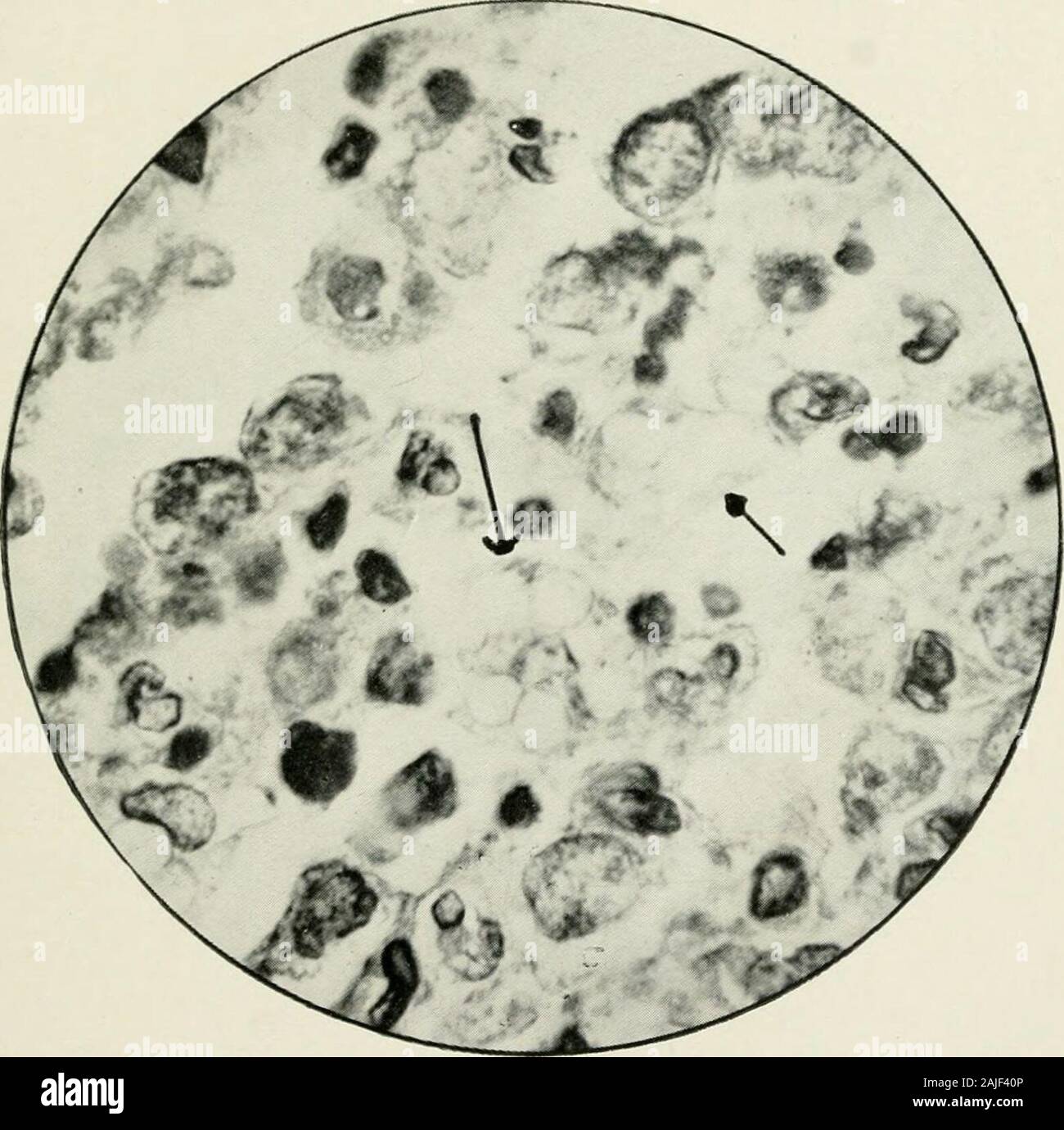 Les rapports médicaux et chirurgicaux . Mosse, Berl. klin. Wchnschr., 1907, xliv, 798. 5 Hunter, l'anémie pernicieuse, Londres, 1901, p. 176. 6 Gabbi, Beitr. z. chemin. Anat. u. allg. Chemin d'accès. (Zieglers), 1893, xiv, 350. 7 boycotter et Douglas, Jour. Le chemin et le Bacterid., 1910, xiv, 294.S, Weber Deutsch. Arch. f. klin. Med., 1909, xvi, 165. 9 Savtchenko, Ann. de lTnst. Pasteur, 1902, xvi, 106. 10 Levaditi, Ann. de lTnst. Pasteur, 1902, xvi, 233. 11 Barratt, Proc. Roy. Soc, Londres, 1905, lxxvi, B, p. 524. 12 Keith, Proc. Roy. Soc, Londres, 1906, lxxvii, B, 537. 13 Neufeld et Topfer, Centralbl. f. Bakteriol., 190 Banque D'Images