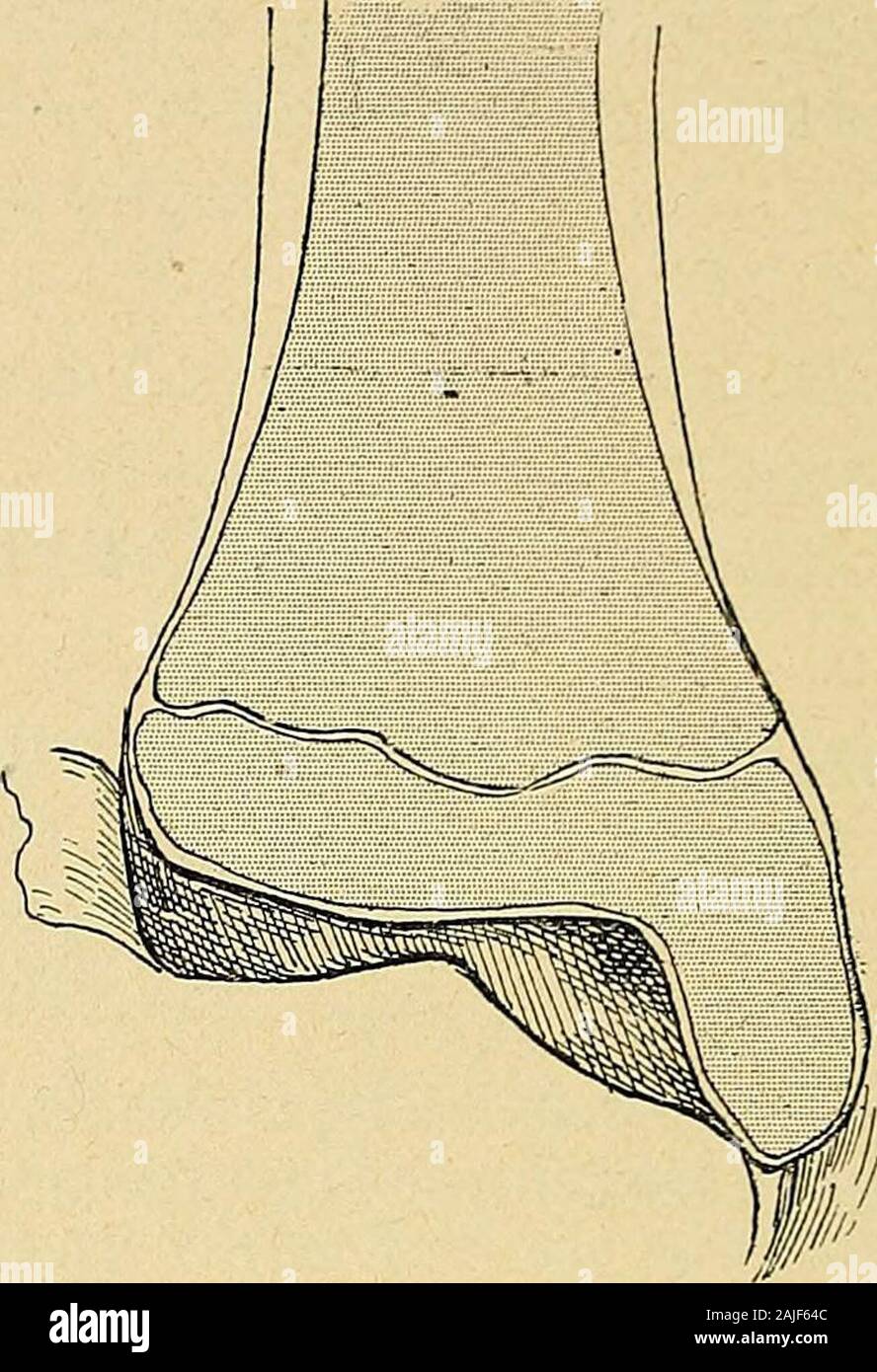 Technique du traitement des tumeurs blanches . Fig. 154. L'ossification de lépiphyse - du Fig. 155. - L'ossification chez un jeune homme de tibia chez un enfant de cinq ans. dix-sept ans. Banque D'Images