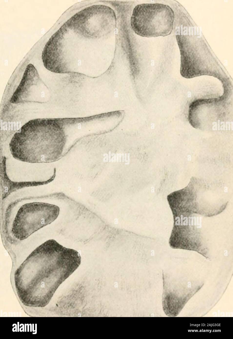 Pathologie : Manuel de bactériologie, y compris la technique du postmortems, et des méthodes de recherche pathologique . givesrise rarement rose d'Altera distinctif dans le rein ; pa-tients atteints avec thedisease infrequentldevelop touchés pas néphrite, proba-blv en raison de la sécrétion continuou&gt;d'irritants re-sulting à partir de lésions out-side le rein. Les tumeurs de l'kidneyare pas commun. De 151)cas recueillis par Morris.63 ont été sarcomata, 41carcinomata ; sa liste une hincludes ofcystic.21 cas de dégénérescence et de 11kyste hydatique ; il y a eu10 adenomata. D thesarcomata, soixante-cinq pour cent, se produire dans Banque D'Images