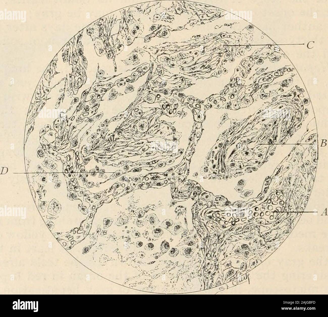 Pathologie : Manuel de bactériologie, y compris la technique du postmortems, et des méthodes de recherche pathologique . e et sutTiciently à liquide pour permettre la formation d'abcès dans la pneumonie lobaire voir p. 594. Ganpreneresulting de pneumonie lobaire est là aussi describefl. 6o4 pathologie spéciale de l'extrusion. des vésicules séminales et de l'expectoration. La quantité de partie par l'absorption pulmonaire peuvent être supérieures à celles qui s'échapper par thebronchi, ou l'inverse. La quantité d'exsudats (byweighing estimé le poumon normal et en déduisant son poids à celui d'theinflamed orgue) varie pour l'ensemble de l Banque D'Images