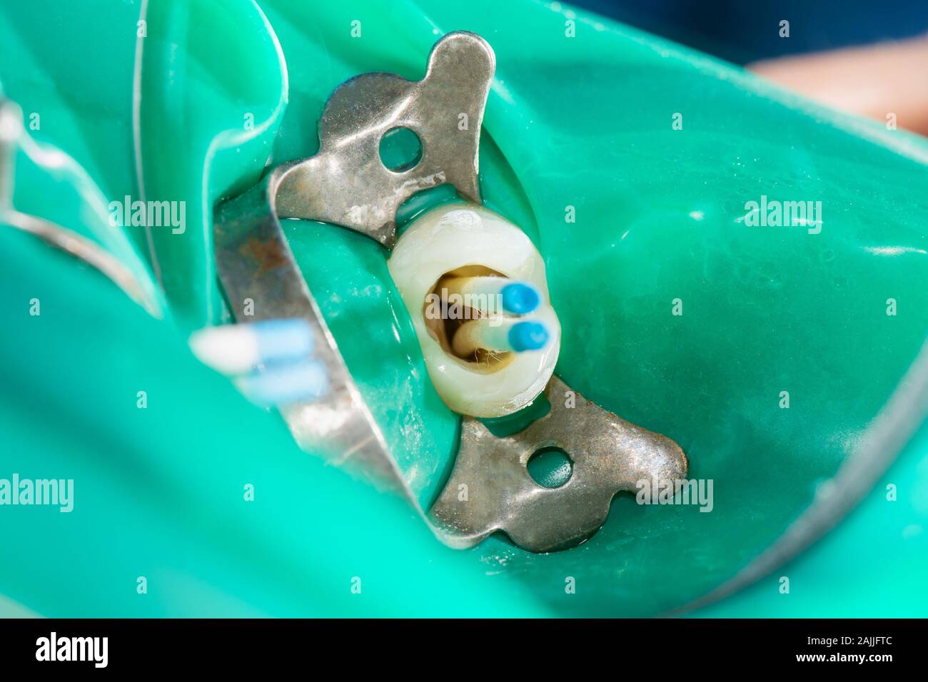 Photo d'un traitement endodontique de canaux dentaires dans la molaire inférieure molaire dent permanente avec fichier d'endodontie avec localisateur d'apex, dent avec pince Banque D'Images
