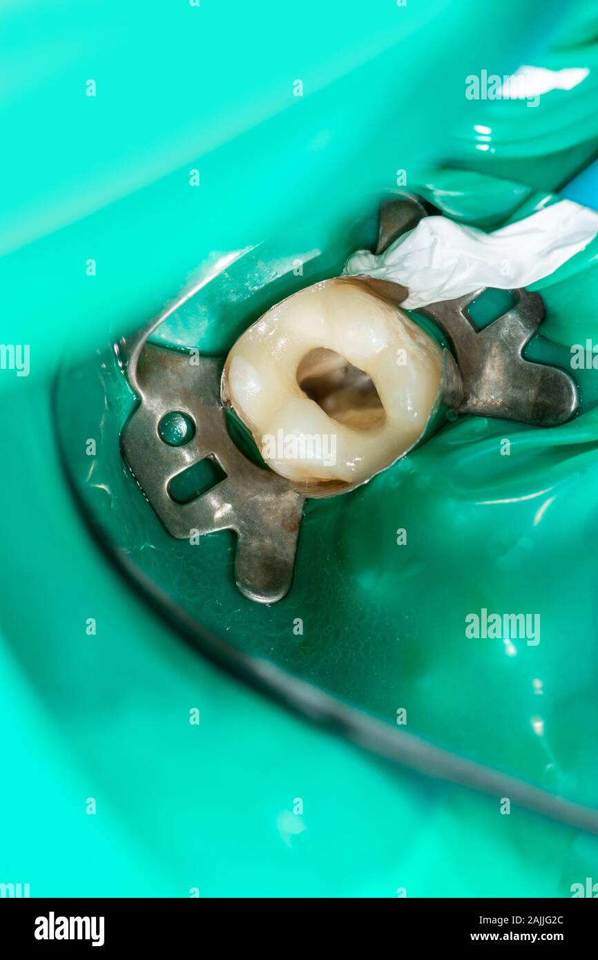 Photo d'un traitement endodontique de canaux dentaires dans la molaire inférieure molaire dent permanente avec fichier d'endodontie avec localisateur d'apex, dent avec pince Banque D'Images