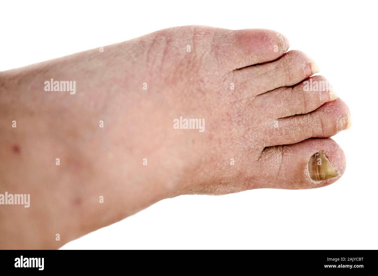 Mycose ongle avec arthrite Banque de photographies et d'images à haute  résolution - Alamy