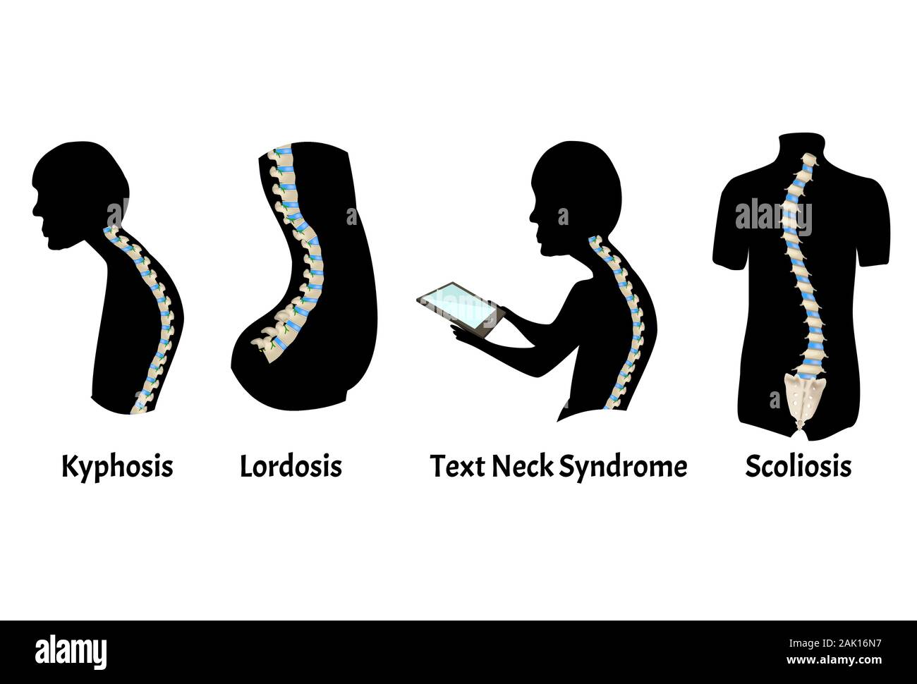 La position de la colonne vertébrale avec cyphose, lordose. Le syndrome du cou du texte. La courbure de la colonne vertébrale, la scoliose, lordose, cyphose, arthrose. Une mauvaise posture et Illustration de Vecteur