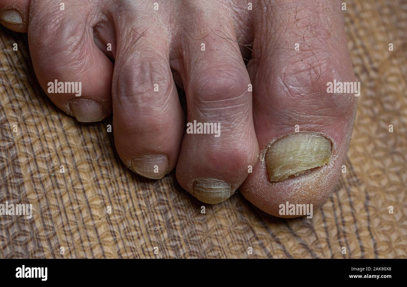 Close up de champignons des pieds et orteils recourbés touchés par la maladie de Parkinson Banque D'Images