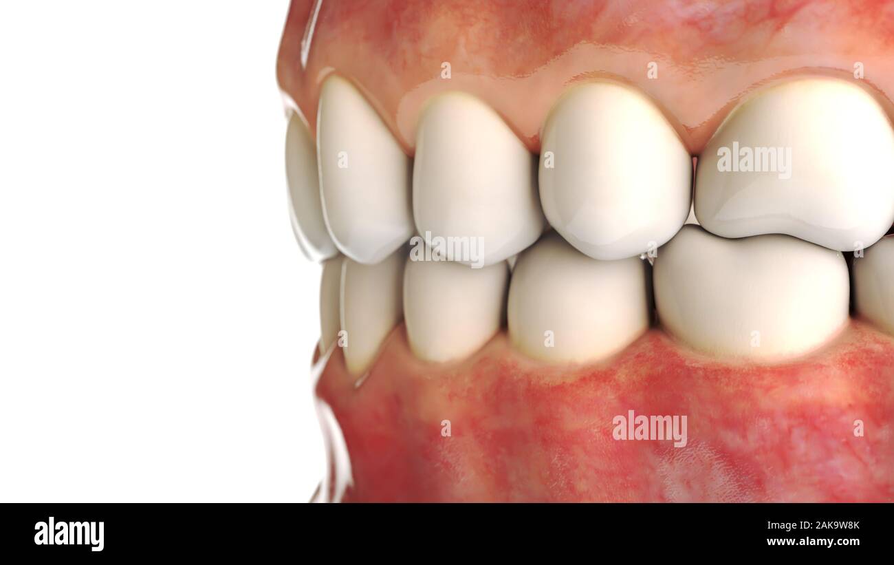Implant dentaire invisible sur fond blanc - le rendu 3D Banque D'Images