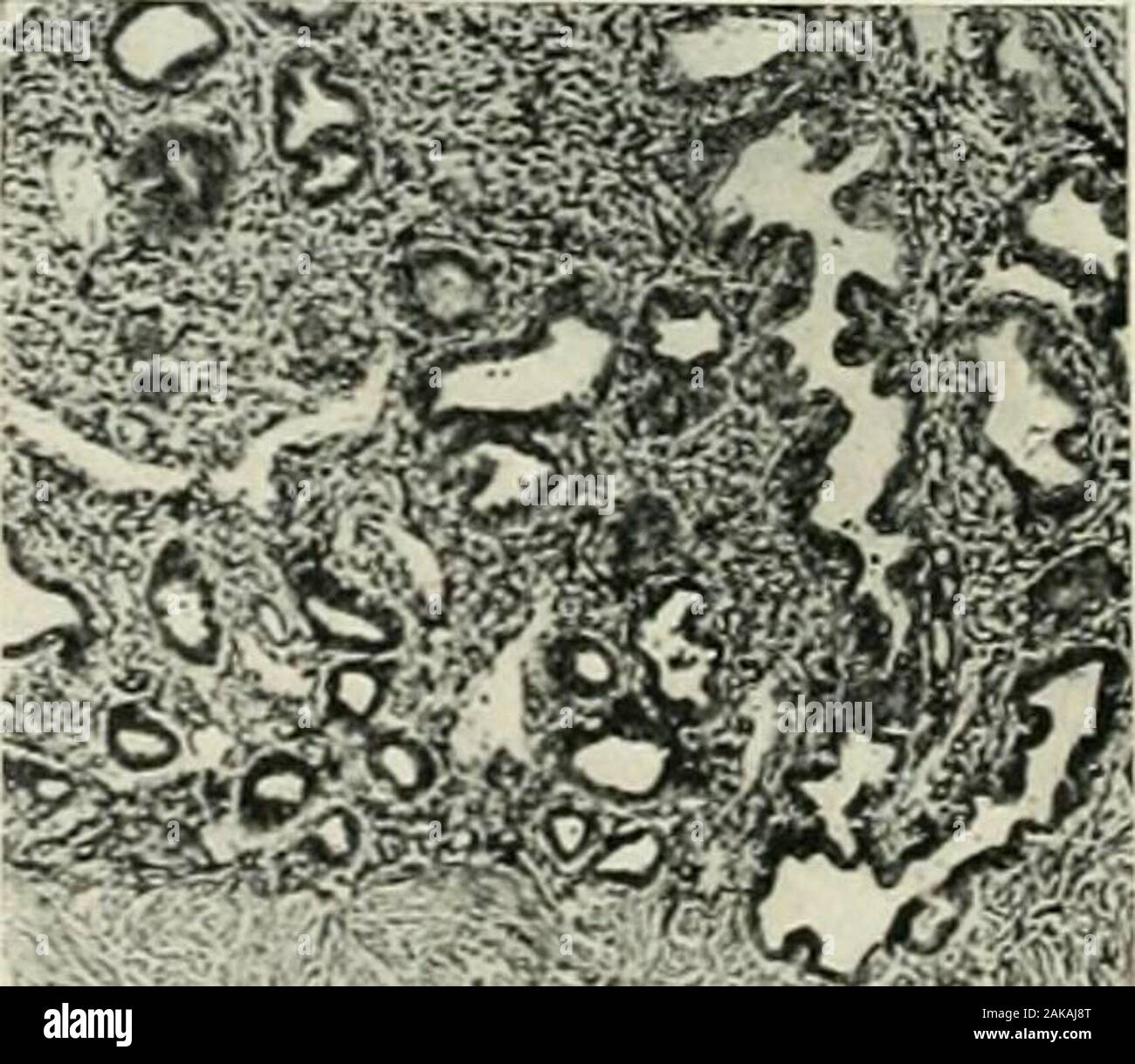 Le diagnostic et la pathologie gynécologique . Fig. -La muqueuse de l'utérus-couche de surface. C'est le stroma cellulaire hautement et contient des vaisseaux capillaires. La surface est coveredwith une seule couche d'épithélium cylindrique cilié qui est. Les cellules sont flying masai hautes que celles de la muqueuse du col de l'memhrane situatedin et le noyau est le moyen, non pas à la base de la cellule. L'épithélium descend dans atintervals sous forme de simples tubes, les glandes utérines. Ces glandes ne notrun verticalement et sont donc considérées à couper dans des directions différentes.. •V ?o^ : Fig. 73.-muqueuse de l'utérus-couche profonde. L Banque D'Images