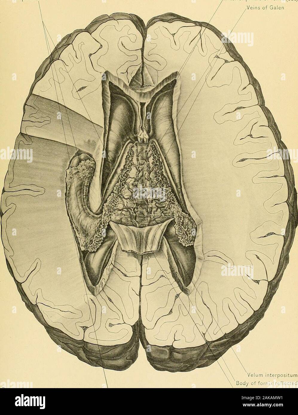 Anatomie chirurgicale : un traité sur l'anatomie humaine dans son application à la pratique de la médecine et de la chirurgie. ou partie de cette fissure transversale, throughwhieh le velum interpositum passe, est la continuation de l'interspace entrele cerveau et cervelet vu dans le undissected materremoved du cerveau de l'EFVP. Cette partie centrale est en continuité avec les parties latérales, ou hippo-campal fissures, qui sont considérés dans la dissection du moyen cornua lesécrous de ventricules, faisant ainsi de la fissure, dans son ensemble, en forme de fer à cheval. Le troisième ventricule est une étroite cavité oblongue, situa Banque D'Images