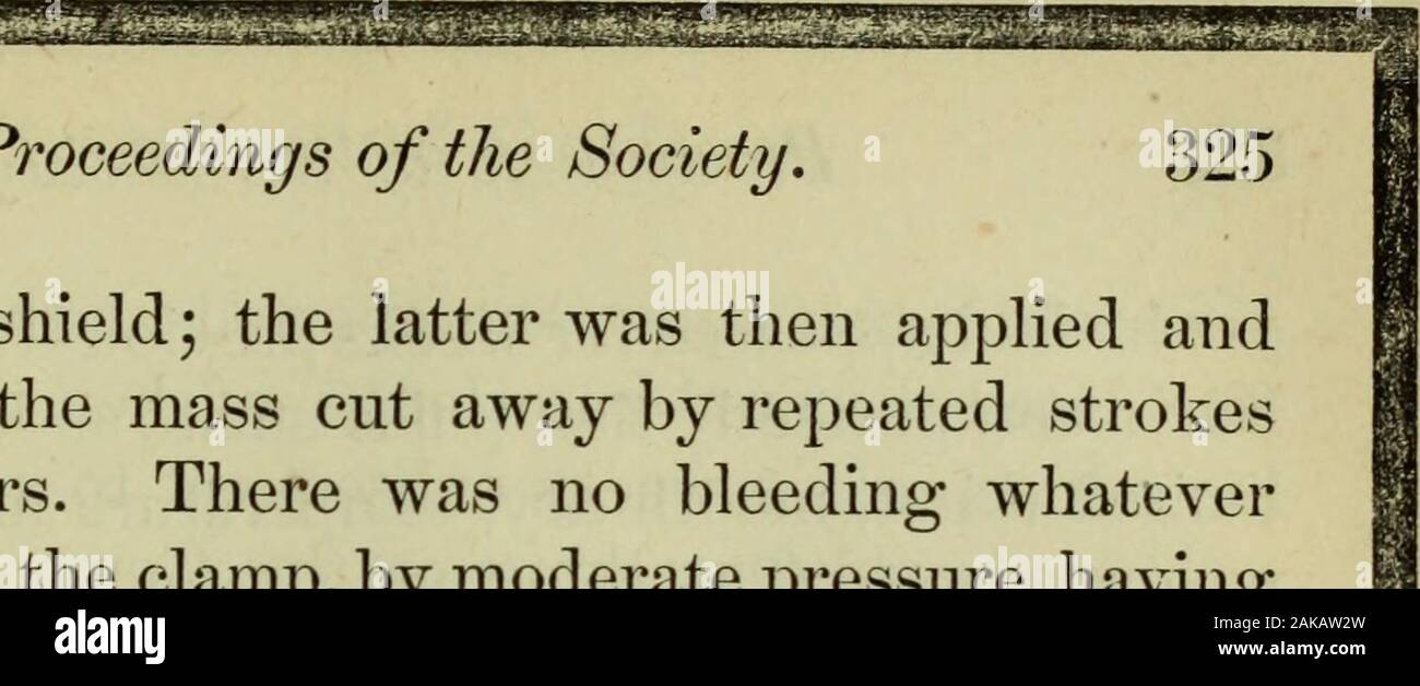 Le journal de la société gynécologique de Boston : une revue mensuelle consacrée à l'avancement de la connaissance des maladies des femmes . Le patient sous son influence. Les étapes de l'opération ont été comme d'habitude maintenant pur-poursuivi par le Dr H. R. stockeur. Une petite incisionwas exploratoire fait d'abord, et, après le diagnostic avait été confirmé, la blessure a été élargie au moyen de ciseaux à angle droit. Le corps principal du kyste est foundfree, mais à sa marge latérale droite supérieure et itproved adhérent, pour une large mesure, de l'augure-tum. Les adhésions ayant été soigneusement tiré oifand Banque D'Images