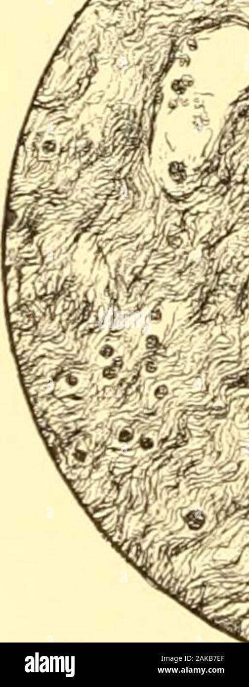 Polype Nasal Banque D Image Et Photos Alamy