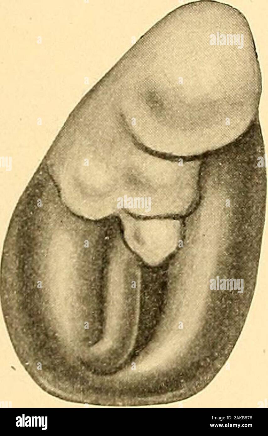 Polype Nasal Banque D Image Et Photos Alamy