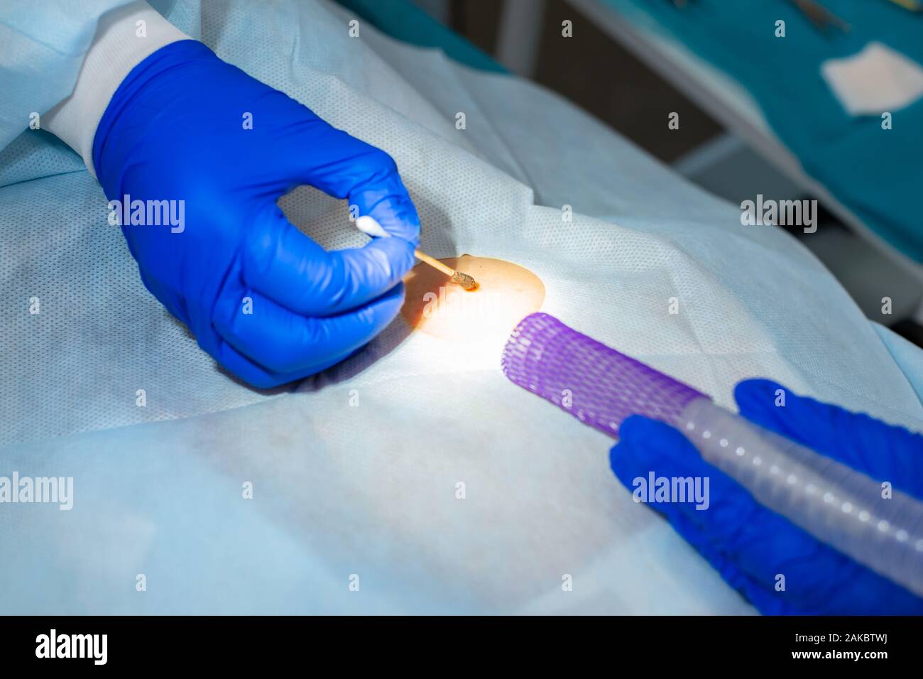 Close-up chirurgien burns une taupe sur le dos du patient. Procédure de chirurgie de déplacement de taupe. Banque D'Images