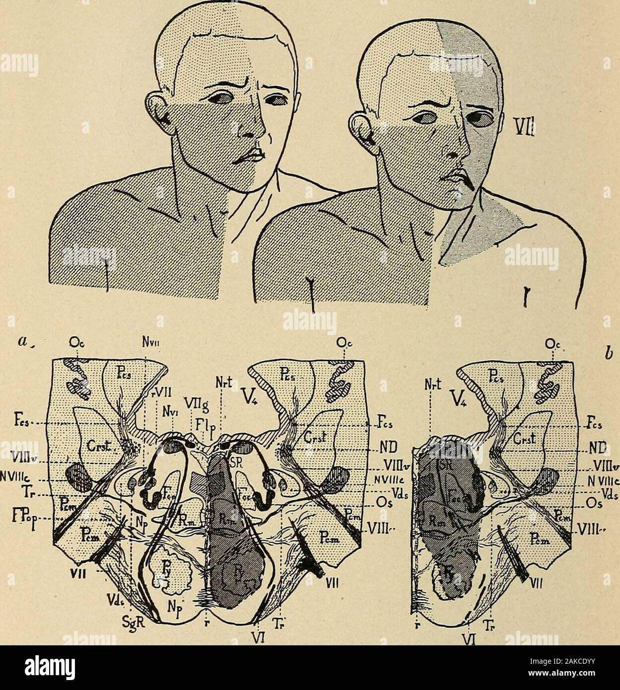 Les maladies du système nerveux : un texte-livre de neurologie et psychiatrie . Foville, avec paralysie secondaire peut être de la sixième seul nerf (un)ou de la sixième et septième (a et b). À ce niveau la cortico-nuoleo haveleft-fibres faciales la voie pyramidale avec le meduUopontine fibres aberrantes (voir planche II) dans l'andare, otorhinolaryngologie désignant d'où l'absence de l'infériorité de la paralysie faciale controlatérale. À droite, il y a une hémiplégie des extrémités sans paralysie du facial inférieur. Pour la gauche il y a strabisme convergent) international par paralysie du muscle grand droit externe;la prédominance de l'e Banque D'Images Les maladies du système nerveux : un texte-livre de neurologie et psychiatrie . Foville, avec paralysie secondaire peut être de la sixième seul nerf (un)ou de la sixième et septième (a et b). À ce niveau la cortico-nuoleo haveleft-fibres faciales la voie pyramidale avec le meduUopontine fibres aberrantes (voir planche II) dans l'andare, otorhinolaryngologie désignant d'où l'absence de l'infériorité de la paralysie faciale controlatérale. À droite, il y a une hémiplégie des extrémités sans paralysie du facial inférieur. Pour la gauche il y a strabisme convergent) international par paralysie du muscle grand droit externe;la prédominance de l'e Banque D'Images