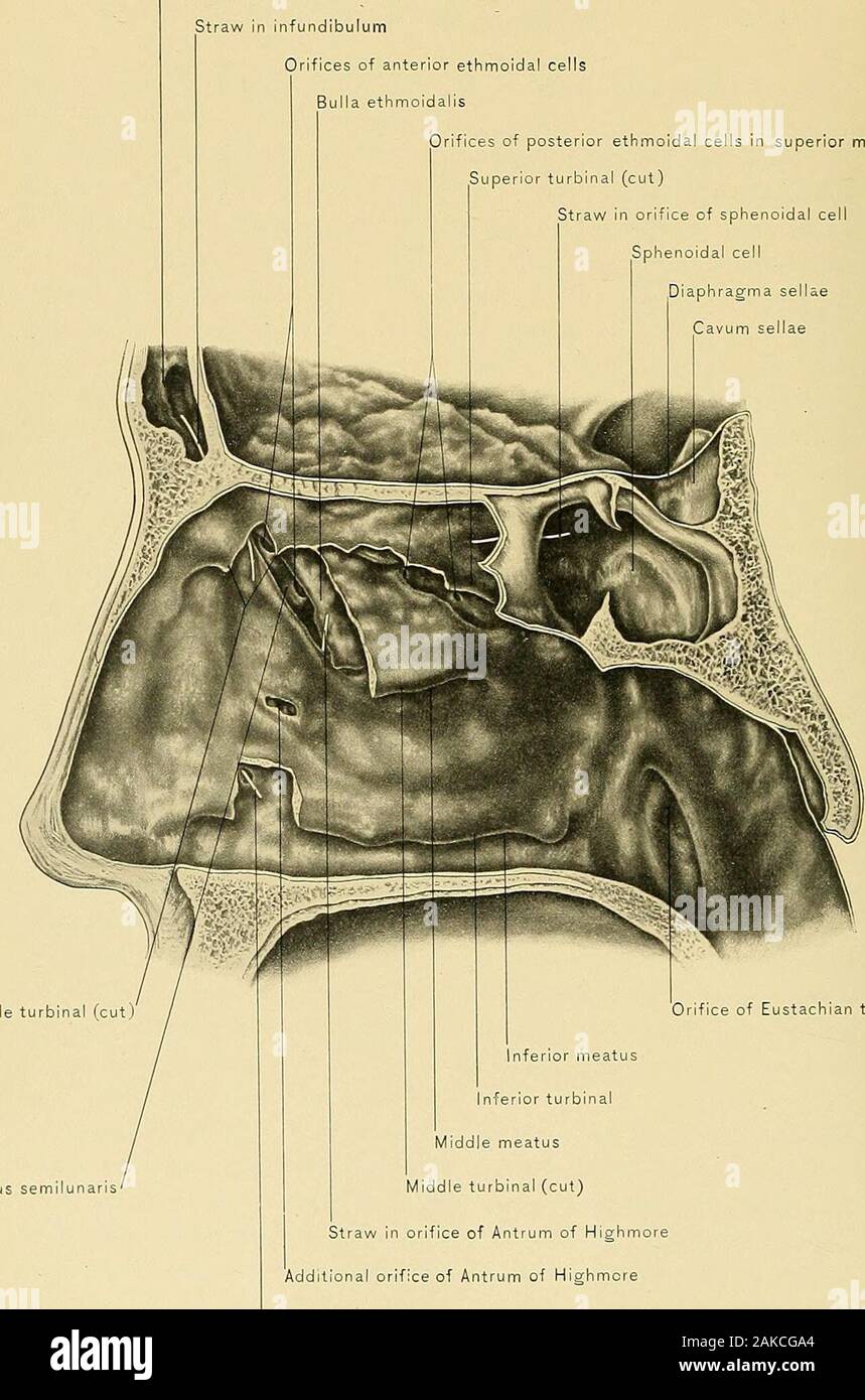 Anatomie chirurgicale : un traité sur l'anatomie humaine dans son application à la pratique de la médecine et de la chirurgie. le milieu du méat du nez. L'orifice est petit et rond ou elliptique.Dans l'empyème et mucocèle de l'antre l'orifice est généralement fermée par épaissir-ing de la muqueuse nasale dans la rhinite allergique. Il y a peut-être un ou moreadditional orifices menant dans la fosse nasale. Les tumeurs dont l'origine se trouve dans l'antre peut être maligne ou bénigne.par la pression sur les parois du sinus ils empiètent sur l'orbitale et nasalfossse, conduit lacrymal, pterygo-région maxillaire, et pe Banque D'Images