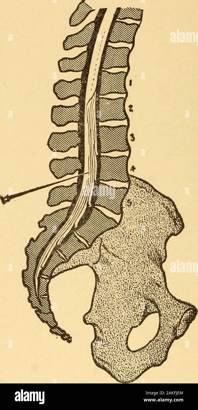 Anaesthesia anaesthetics et général et local . Fig. 47.-crêtes iliaques. brae est généralement sélectionnée. Chipault utilisé l'espace entre les couples lesvis vertèbre lombaire et le sacrum, qui est aussi byRodman préféré. Corning d'abord utilisé l'espace entre le eleventhand douzième vertèbres dorsales, mais plus tard préféré que thefourth entre et la cinquième vertèbre lombaire. Tait et Cagliari, de SanFrancisco, ont injecté aussi haut que le sixième de l'espace cervical, butmost injections condamner les autorités plus que le secondlumbar vertèbre. Emplacement et mode. La position latérale et la technique 162 LA RACHIANESTHÉSIE alre Banque D'Images