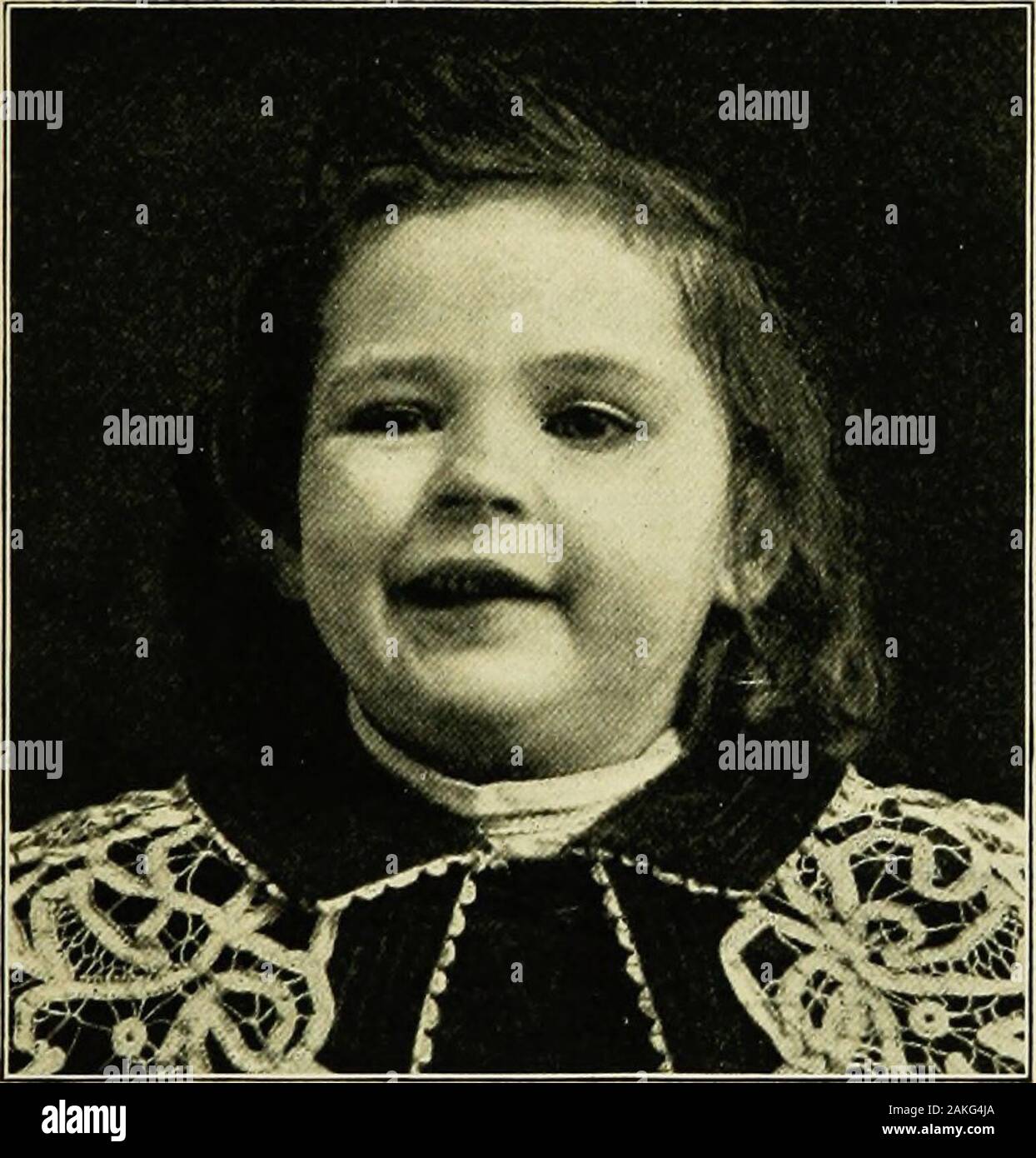 La pratique de la pédiatrie . illitis isusually aucune preuve de rhumatisme présent. Suivant la cause la plus fréquente est la maladie du milieu les maladies nerveuses organiques 889 l'oreille. Cela peut être simplement une implication du nerf par un purulentprocess, ou, plus fréquemment, il suit l'opération sur l'oreille moyenne, withtraumatism au nerf. La troisième et moins souvent la cause est theinvolvement du septième dans le crâne de nerf par la méningite, fractureat la base, des inflammations, des tumeurs ou un abcès de la Pons entre thenucleus du nerf et sa sortie. Symptomatologie.-Dans la mesure où le septième nerf est purel Banque D'Images La pratique de la pédiatrie . illitis isusually aucune preuve de rhumatisme présent. Suivant la cause la plus fréquente est la maladie du milieu les maladies nerveuses organiques 889 l'oreille. Cela peut être simplement une implication du nerf par un purulentprocess, ou, plus fréquemment, il suit l'opération sur l'oreille moyenne, withtraumatism au nerf. La troisième et moins souvent la cause est theinvolvement du septième dans le crâne de nerf par la méningite, fractureat la base, des inflammations, des tumeurs ou un abcès de la Pons entre thenucleus du nerf et sa sortie. Symptomatologie.-Dans la mesure où le septième nerf est purel Banque D'Images