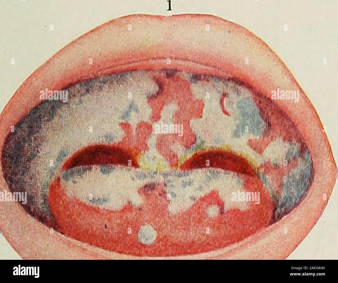 Pediatrie L Hygiene Et Les Soins Medicaux Des Enfants Anes Du Bebe Le Usualplace Qu Il S Affiche Cependant C Est La Muqueuse De Them Ud La Croissance Peut Avoir Lieu Sur Le Carcinome Malpighien